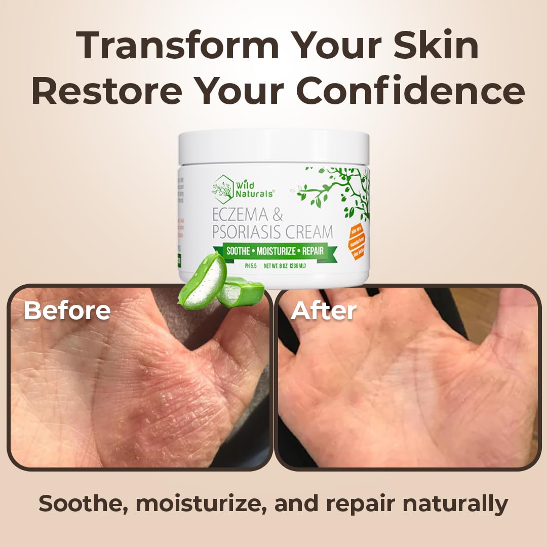 Wild Naturals Eczema & Psoriasis Cream for Dry, Itchy Skin โ Eczema Relief for Adults & Kids โ Moisturizing Psoriasis Cream with Manuka Honey - Image 5