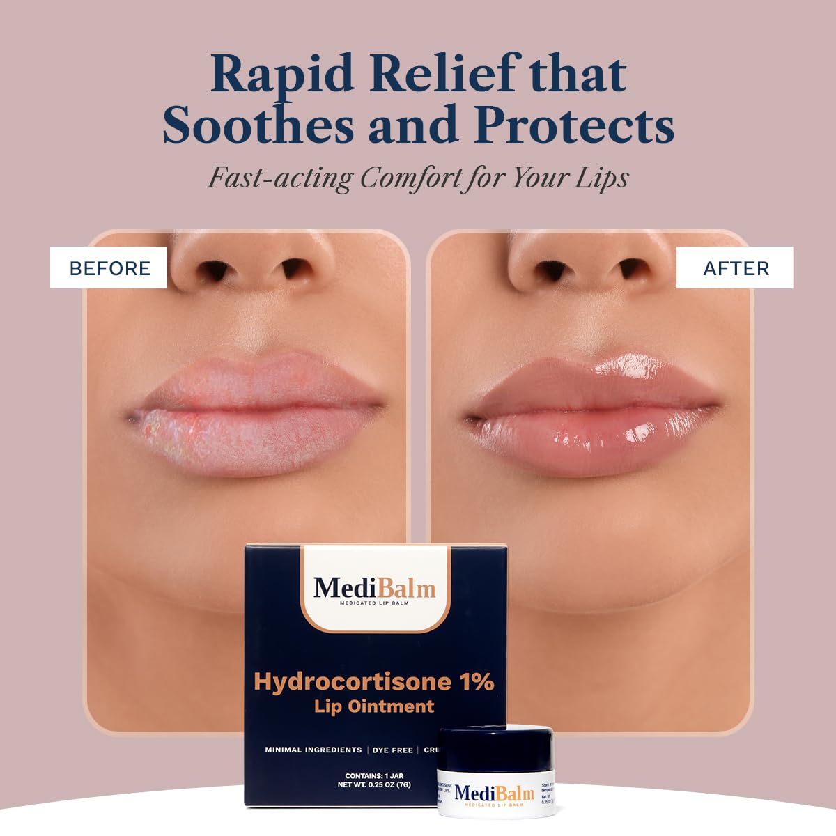 1% Hydrocortisone Lip Balm – Petrolatum-Free Relief for Chapped, Dry, or Irritated Lips due to Accutane, Isotretinoin associated Cheilitis, Weather Damage, and more - Unflavored - Image 3