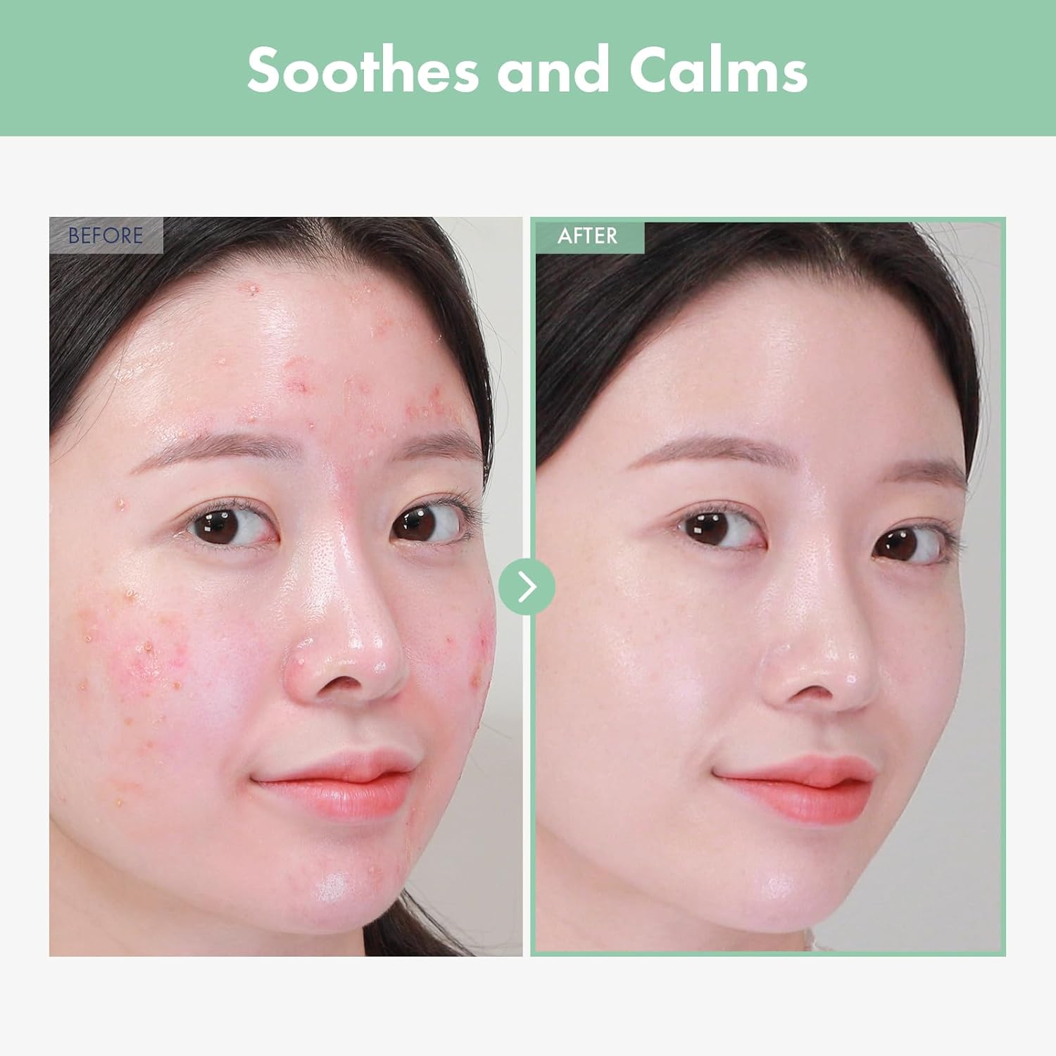 AC Kill Cream, BHA & Salicylic Acid Face Moisturizer, Niacinamide for Active Skin Repair, Tea Tree Oil for Soothing Sensitive Skin, acne spot treatment Korean Skincare, 30g, 1.05 oz. - Image 3