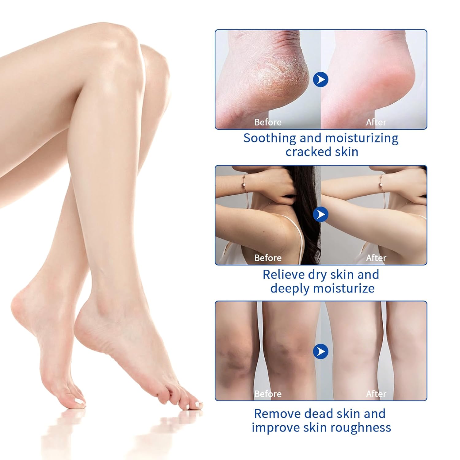 Urea Cream 60% For Feet Maximum Strength, Urea Foot Lotion With 2% Salicylic Acid For Dry Cracked Feet, Heel, Hand & Knee, 5.3 oz Exfoliating Foot Care For Dead Skin, Softening & Deep Moisturizing - Image 7