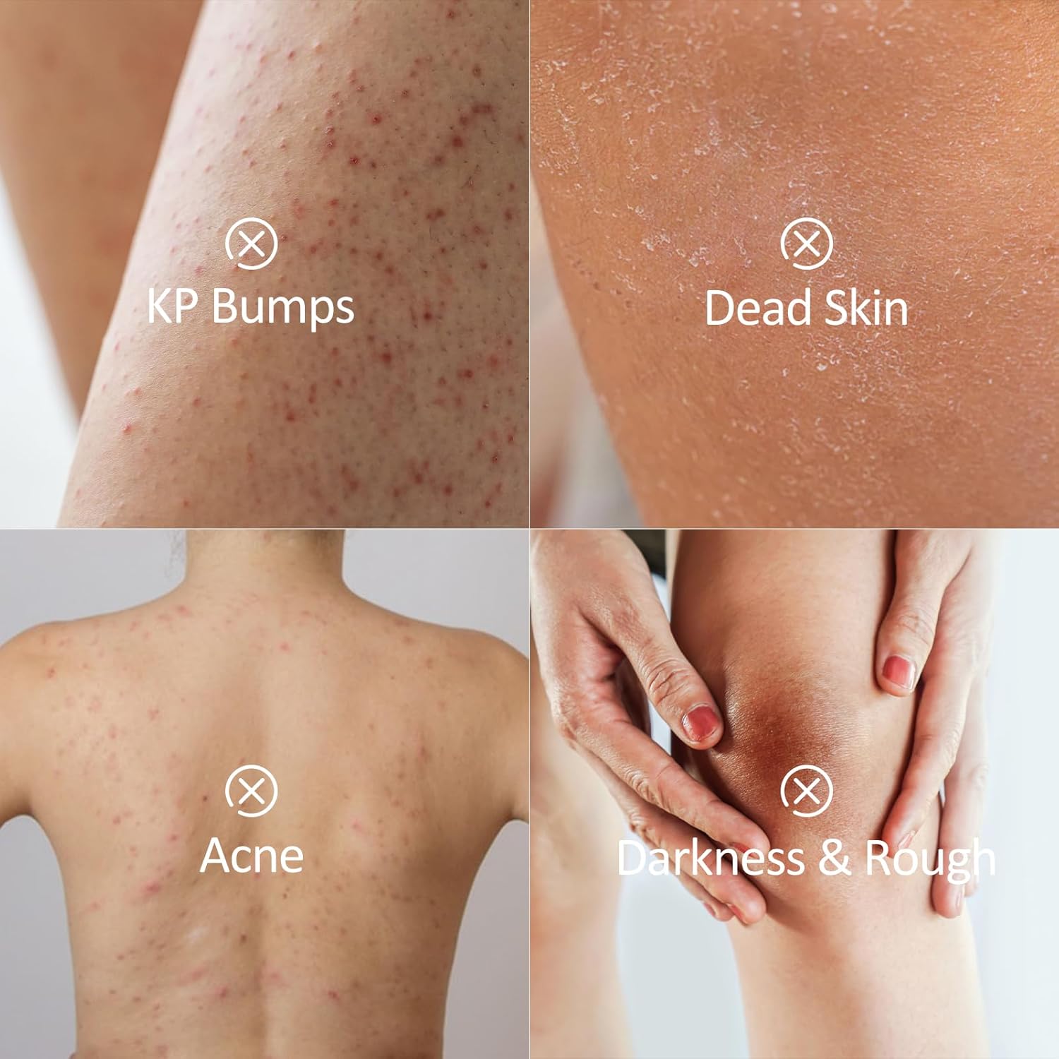 Kp Bump Eraser Body Scrub 300g for Keratosis Pilaris with Salicylic Acid and AHA - Image 4