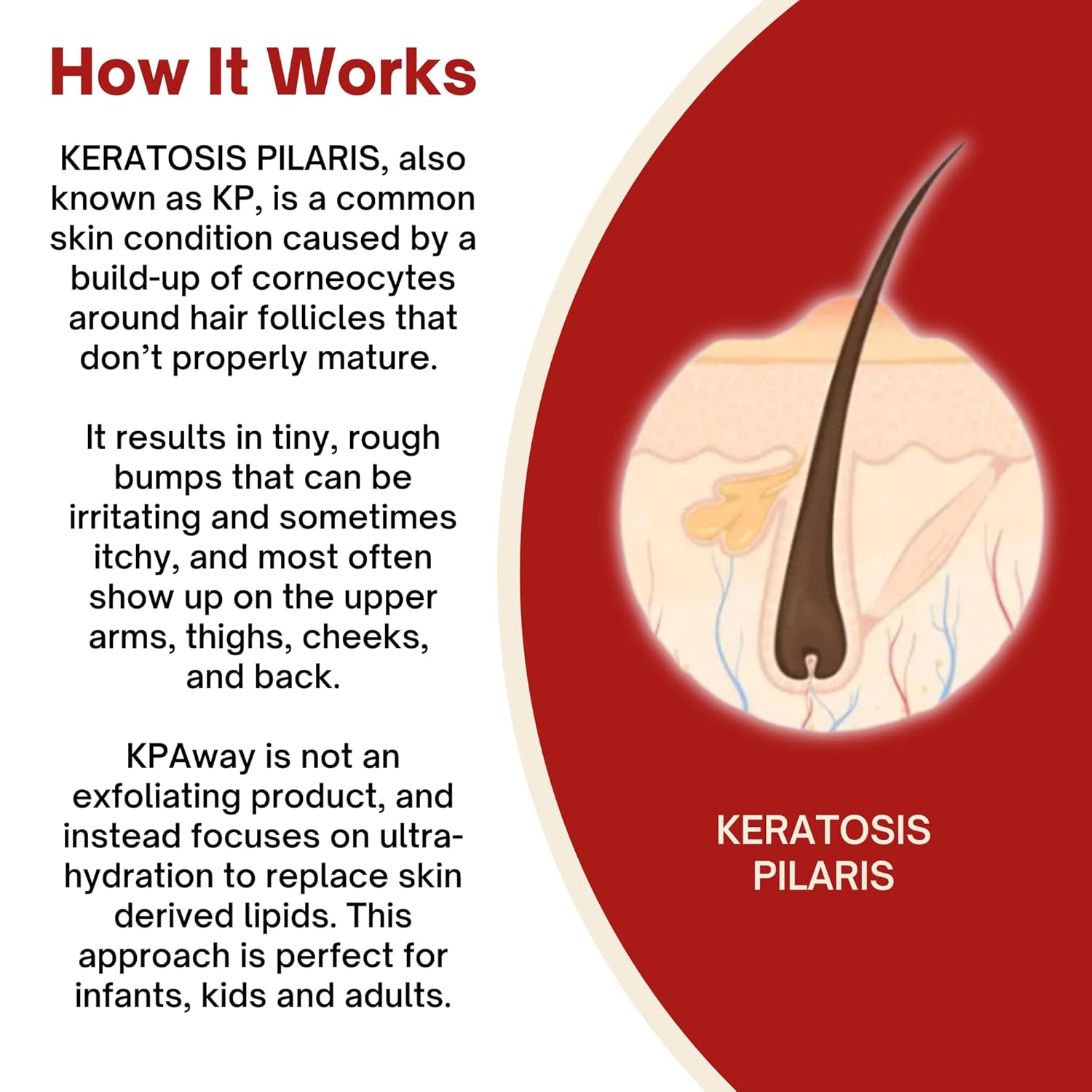 KP Away Moisturizing Keratosis Pilaris Cream for Kids | Gentle Hydration for Dry, Bumpy Skin | Dermatologist-Developed Lotion | Non-Irritating, Acid-Free Formula | 16 oz - Image 4