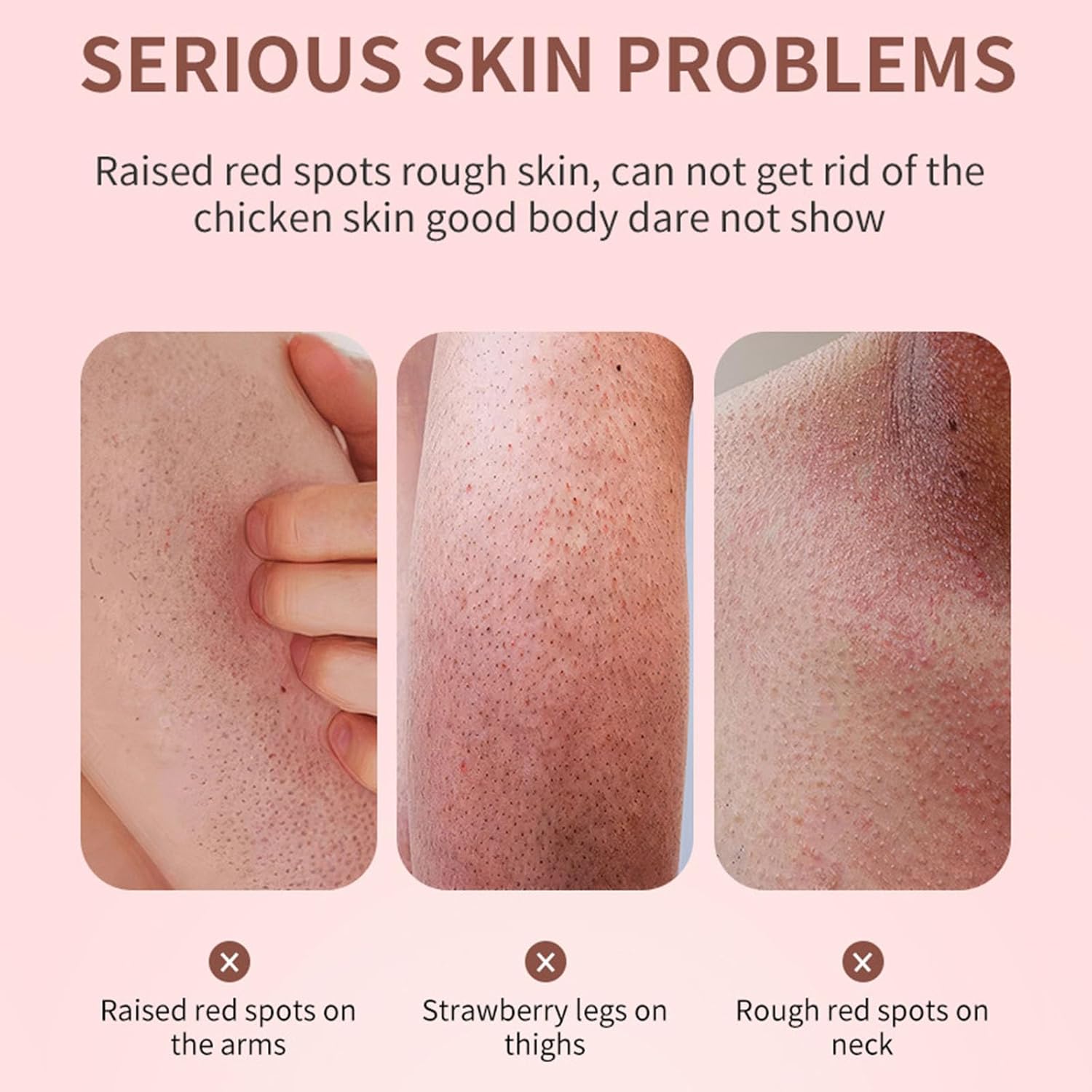 Exfoliating Body Cream for Strawberry Legs Rough Skin Lotion 8 oz - Image 5