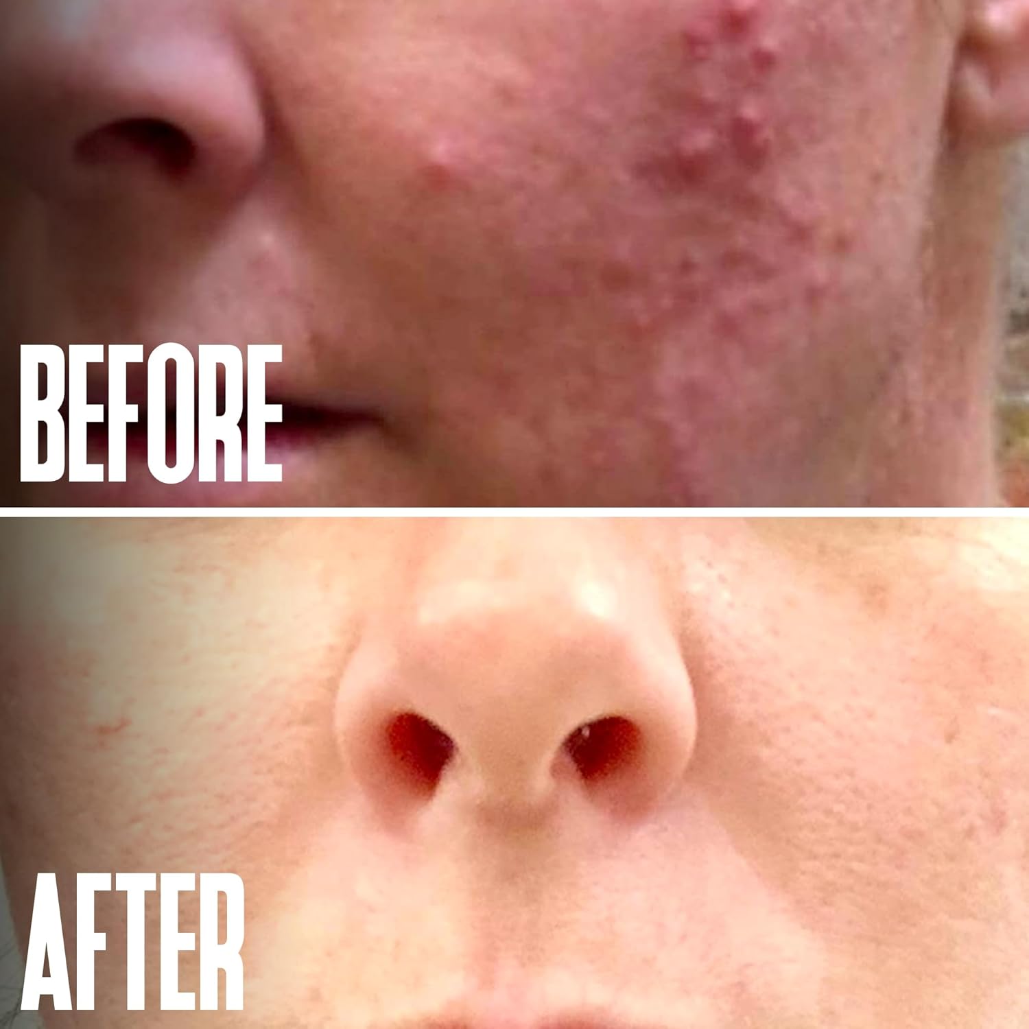 Glycolic Acid Peel 40% Professional Chemical Peel for Face for Acne Scars, Collagen Boost, Wrinkles, Fine Lines - Alpha Hydroxy Acid Liquid Exfoliant for Face Peel Mask for Men & Women - Image 6