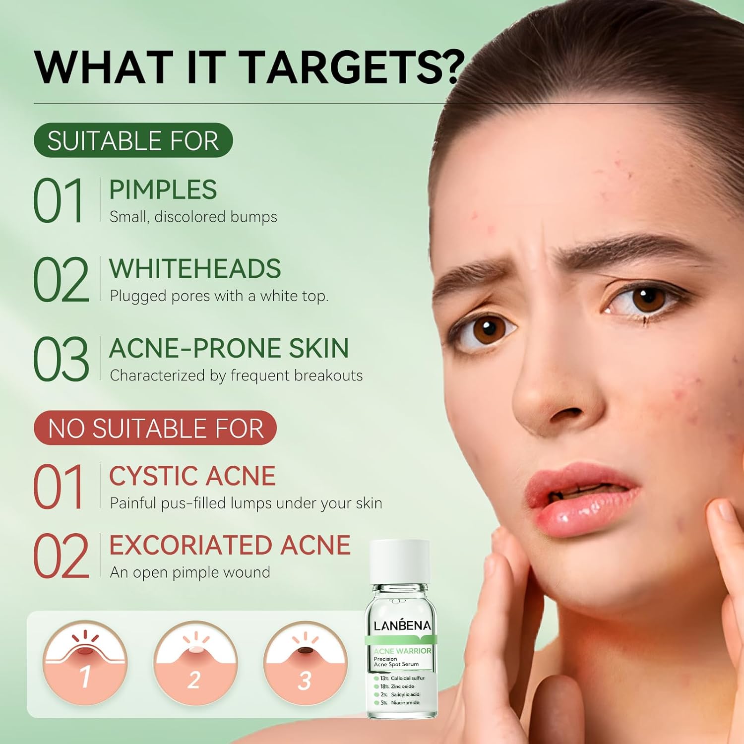 LANBENA Precision Acne Spot Serum, Acne Drying Lotion, Overnight Acne Treatment For Face, Dry Out Pimples, Blemishes, Zits And Clean Pores, 0.42 Fl Oz - Image 3