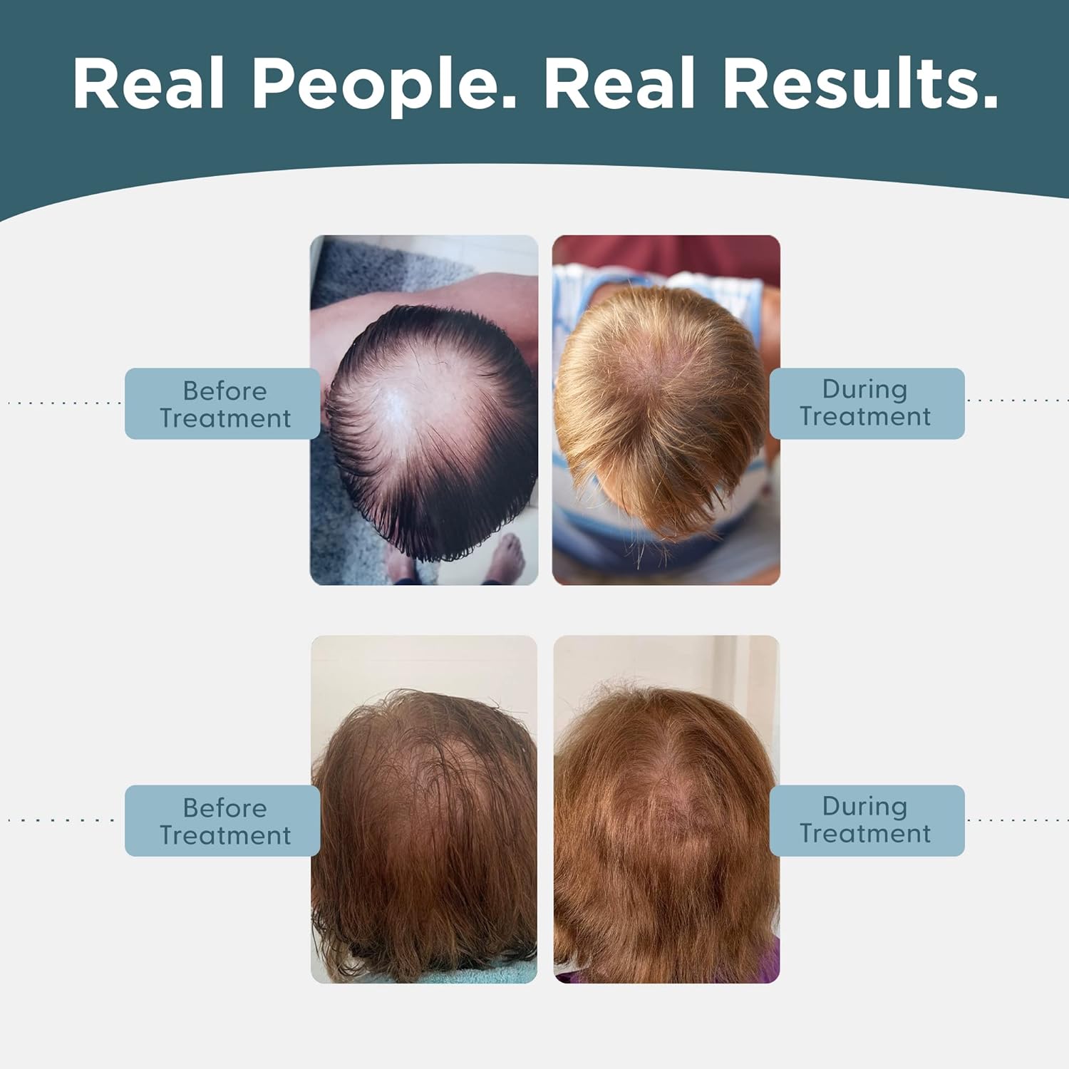 Shapiro MD Men's Hair Regrowth Kit with Shampoo, Conditioner, 5% Minoxidil, 1 Month Supply - Image 5