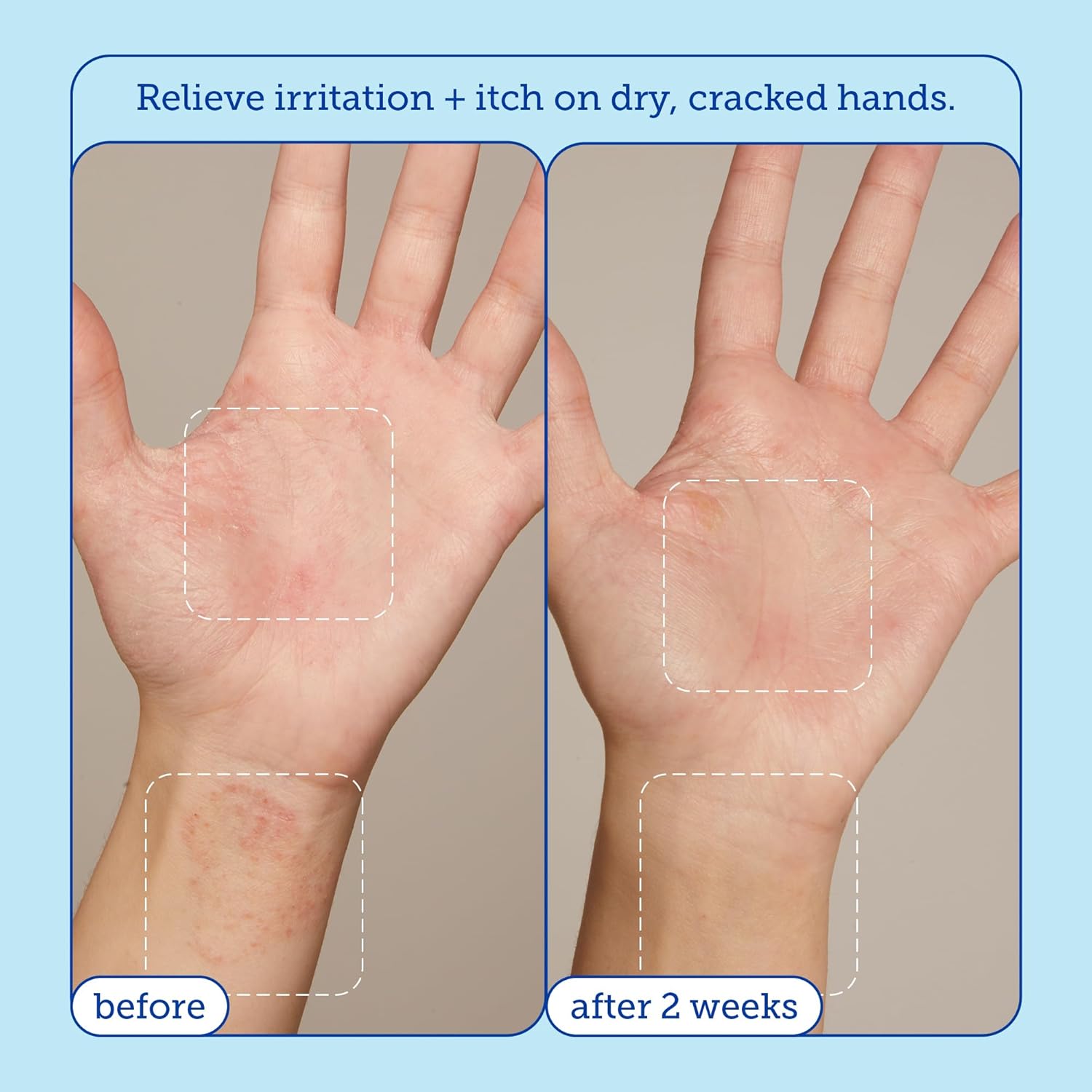 Skinfix Eczema+ Hand Relief Cream: Hydrating Hand Repair Cream to Address Eczema & Dry, Cracked, Sensitive Skin, 3 Fl Oz - Image 4