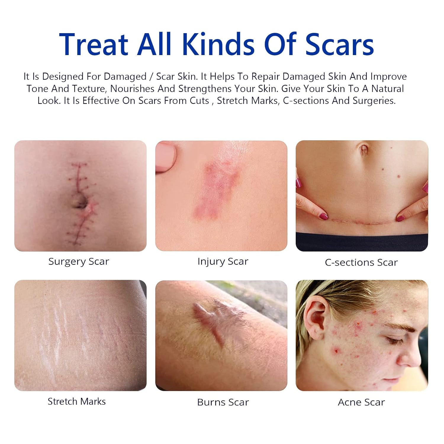 Scar Cream, Scar Removal Cream - Advanced Scar Cream for Surgical Scars, Acne Scars, C-Section, Burns, Stretch Marks -Effective for Old and New Scars Gel Acne Scar Treatment - Image 8