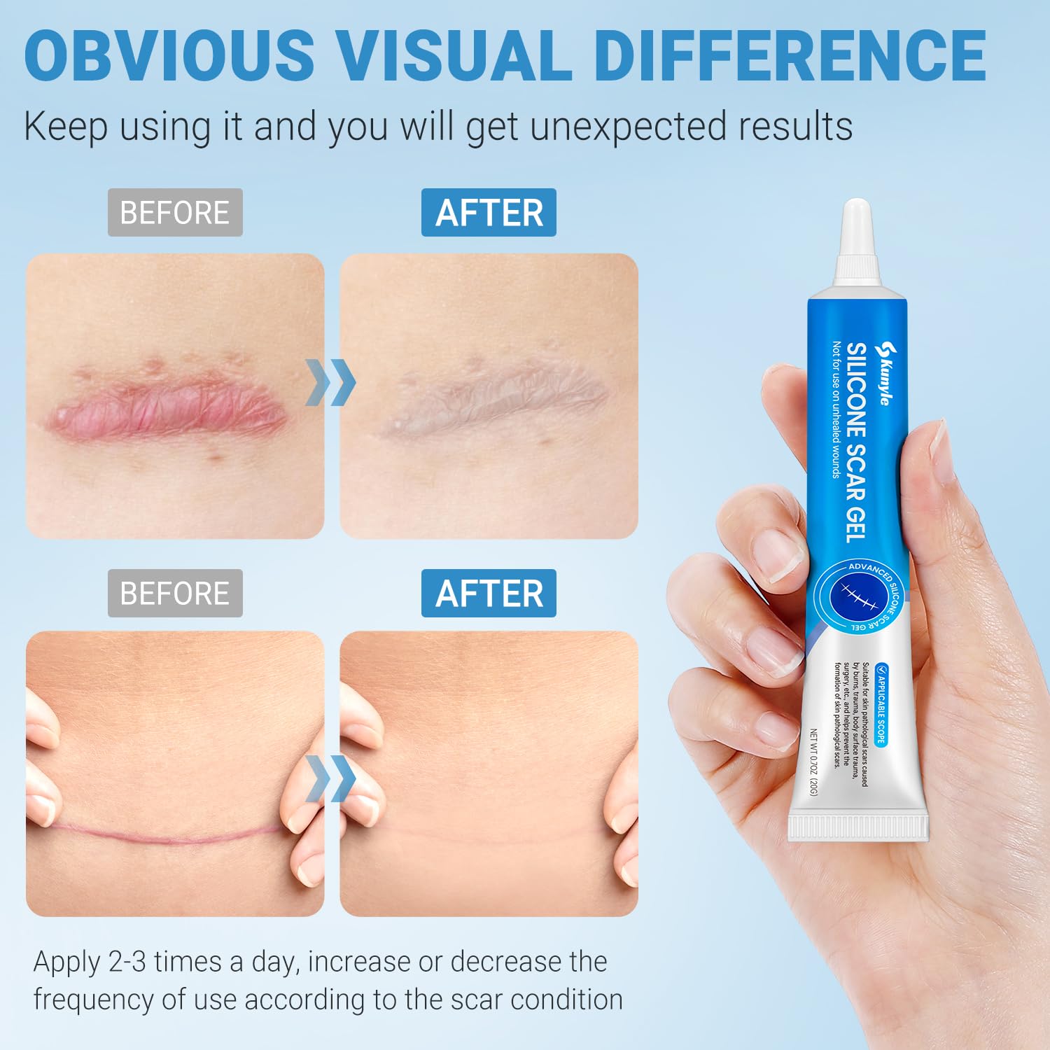 Silicone Scar Gel, Scar Cream, Advanced Scar Gel for Surgical Scars, Stretch Marks, Keloid Bump Removal, Old and New Scars 0.70oz (20g) - Image 3