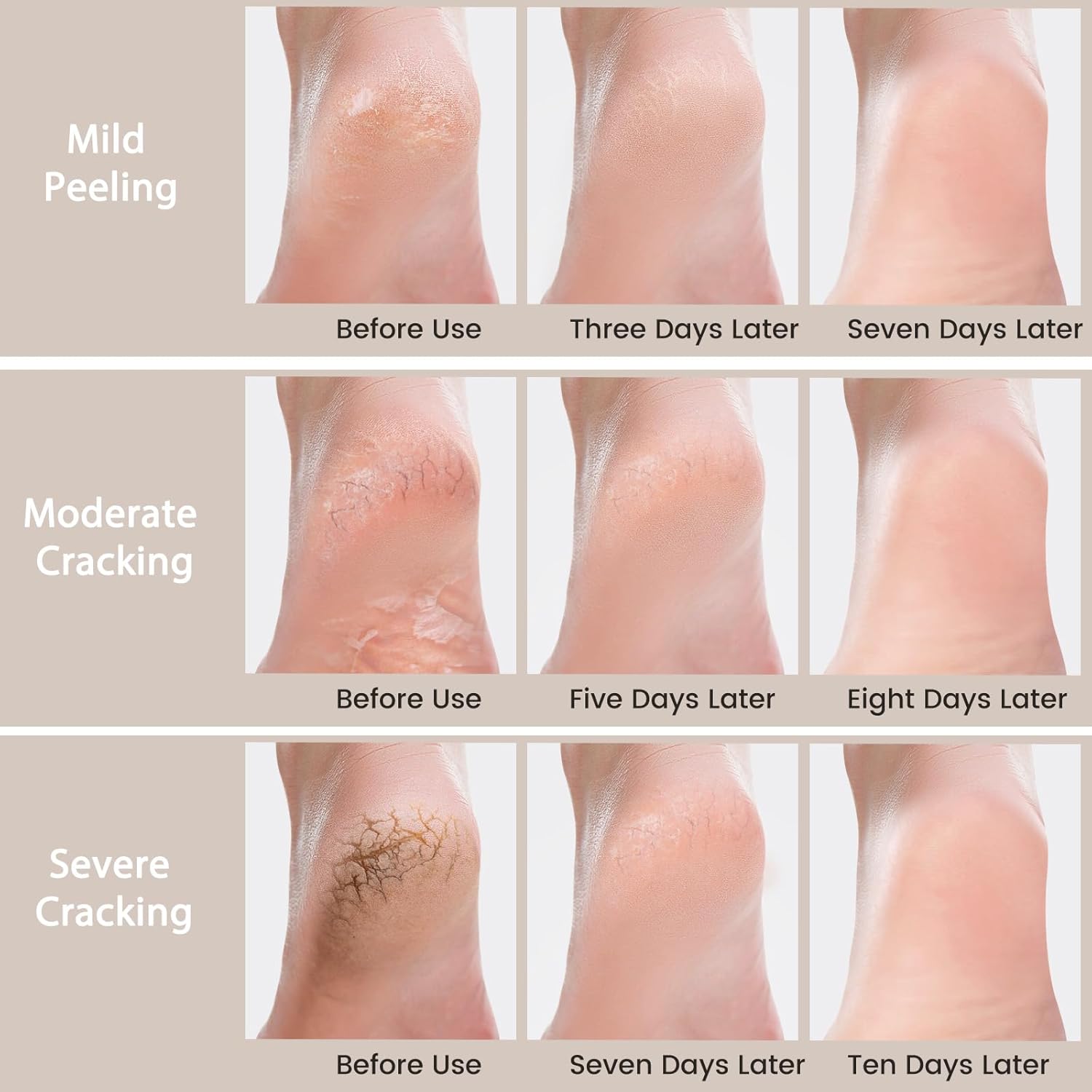 Urea Cream 40 Percent - 8 oz Foot and Hand Cream for Dry, Cracked Skin - Image 6