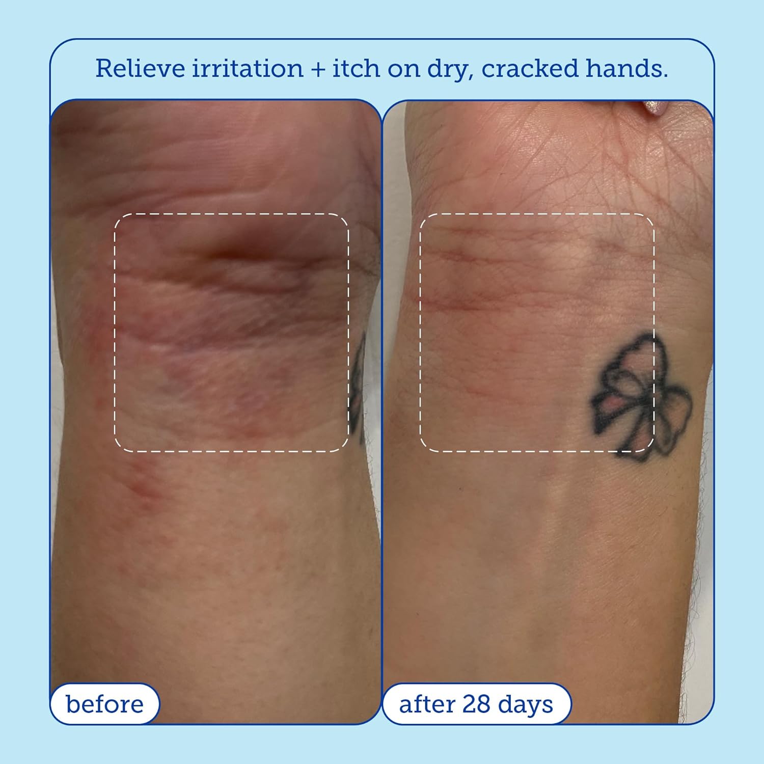 Skinfix Eczema+ Hand Relief Cream: Hydrating Hand Repair Cream to Address Eczema & Dry, Cracked, Sensitive Skin, 3 Fl Oz - Image 5