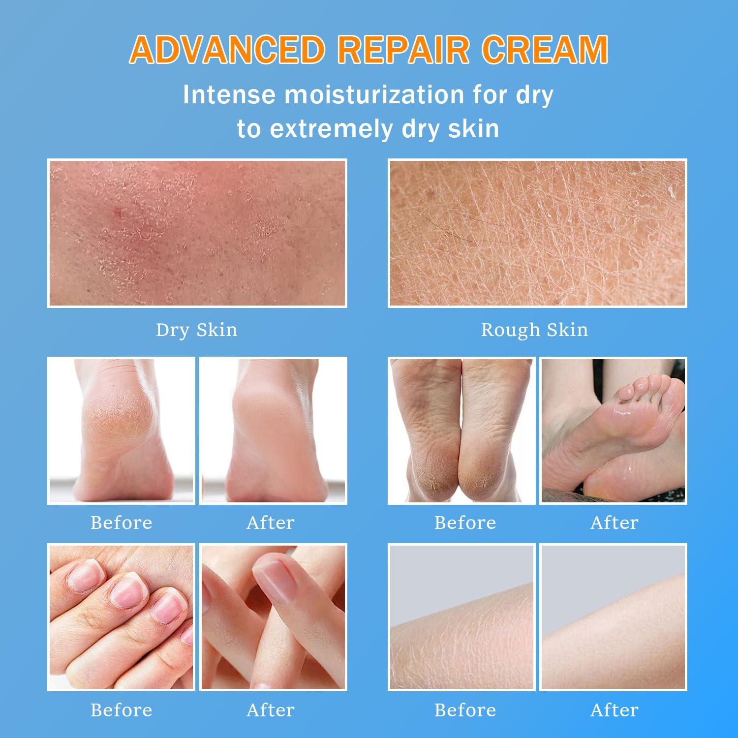 Urea 60% Foot Cream with 2% Salicylic Acid for Dry Cracked Skin, 5.3 Ounce Jar - Image 4
