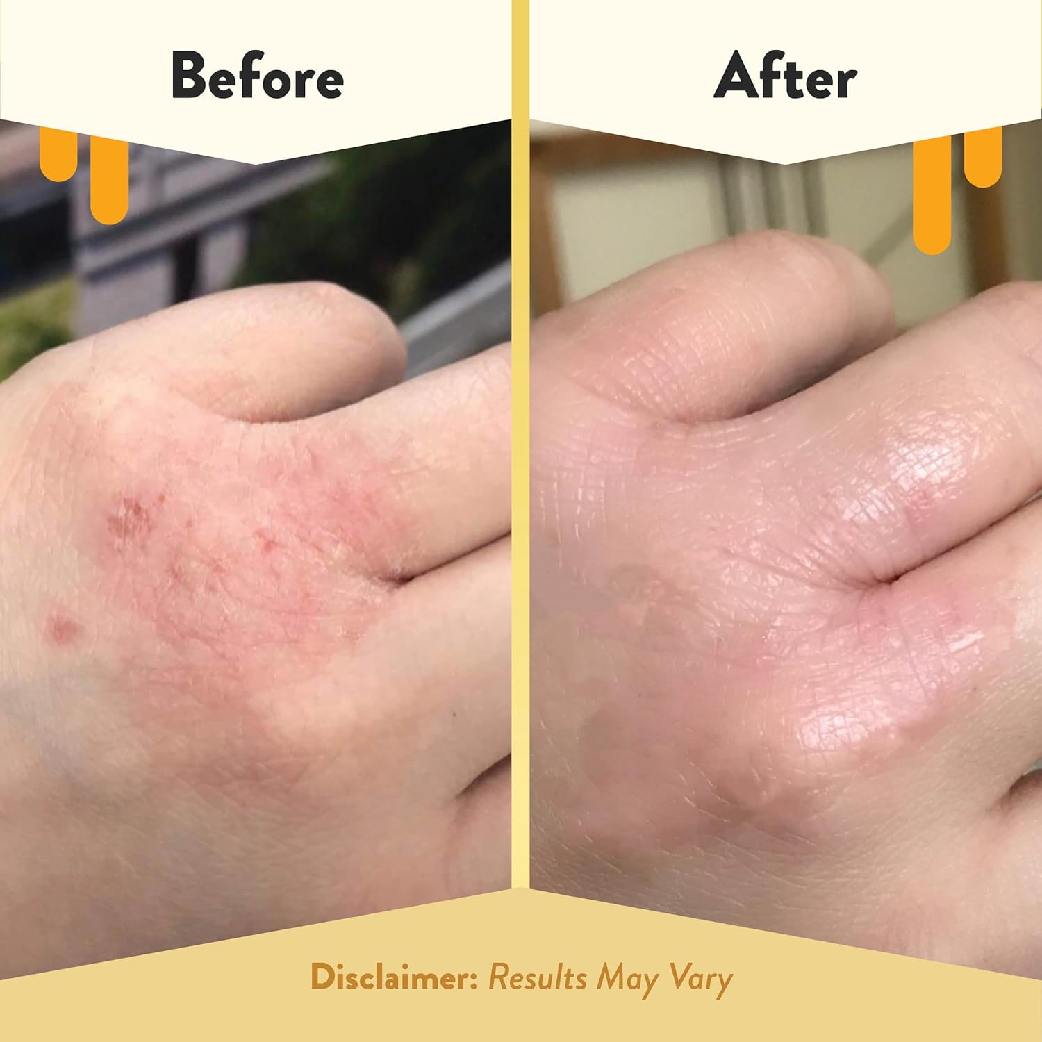 Eczema Honey Nut-Free Original Skin-Soothing Cream 4 Oz Dry Sensitive Itchy Relief - Image 4