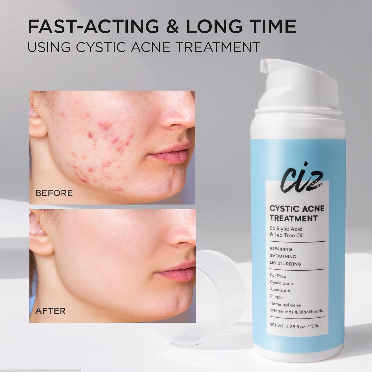 Acne Treatment for Face: Cystic Acne Spot Control Cream with Salicylic Acid & Tea Tree Oil for Blemishes - Gentle Hormonal & Pimple Treatment for Teens & Adults - 120 Day Supply & 3.38oz - Image 5
