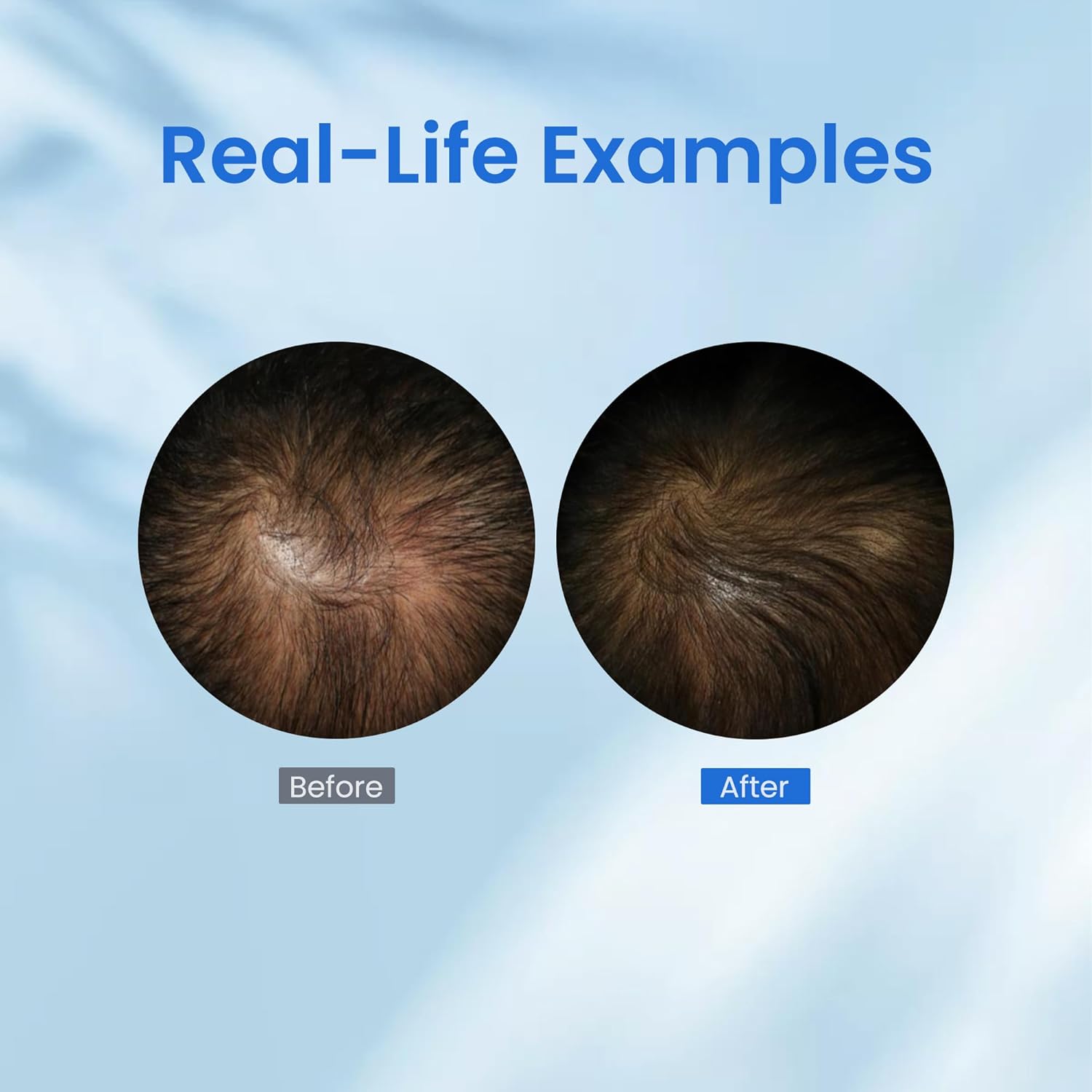0.5% KX-826 DHT Blocker Hair Thickening Growth Products,3 Days Oil Control 1-2 Weeks Hair Loss Reduction 4-6 Weeks New Hair Visible,Hair Growth Spray Regrowth Treatments Men&Women (blue) - Image 2