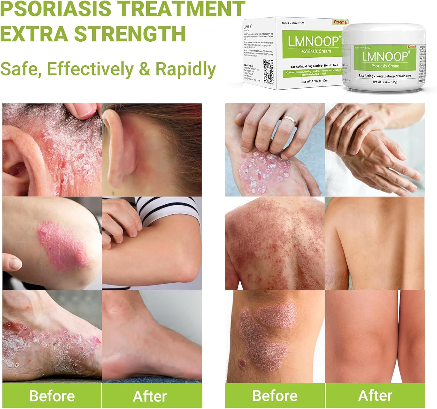 Maximum Strength Psoriasis Cream 3.53 oz Moisturizing Treatment for Itch Redness Flaking - Image 4
