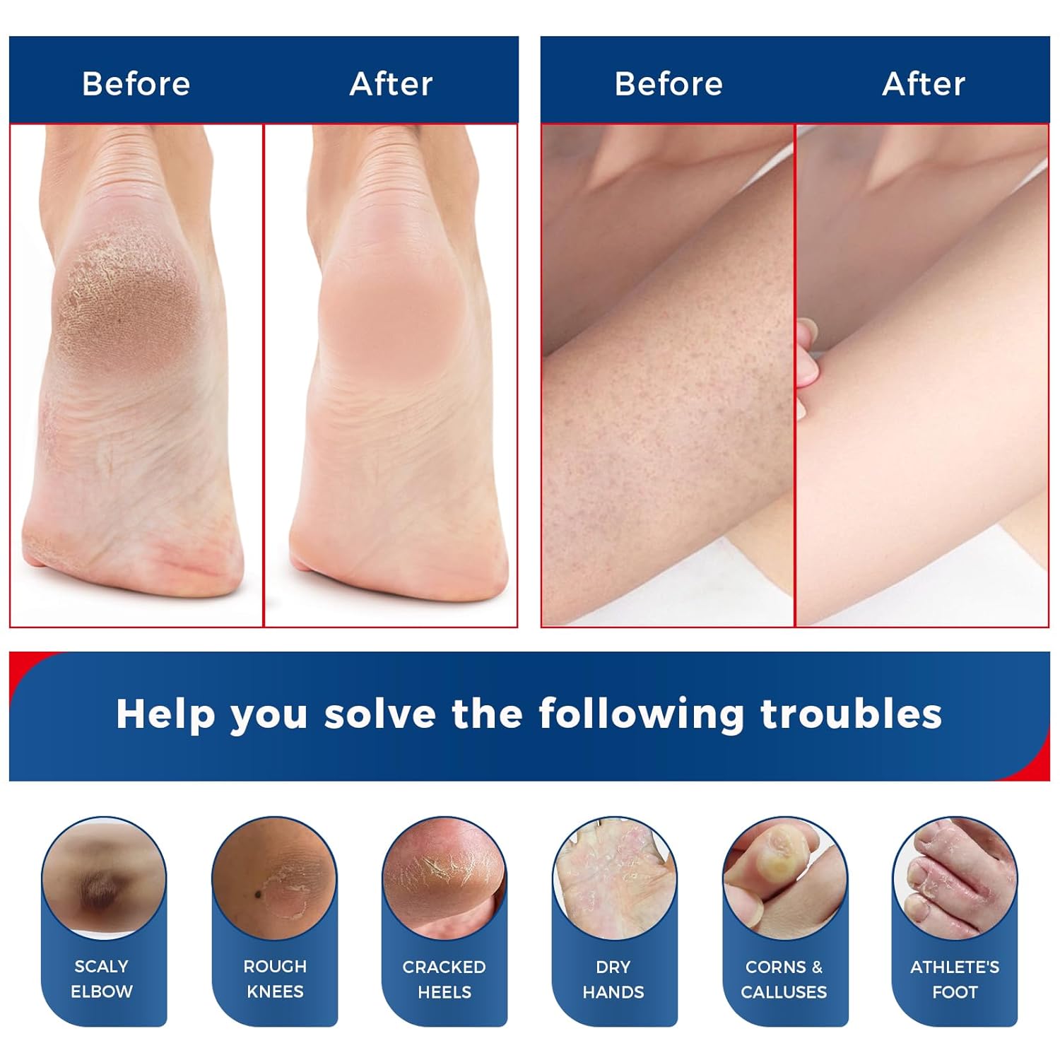 OUKEYA NEW FORMULA Urea Cream 40% Plus 2% Salicylic Acid for Feet Maximum Strength, Dry Cracked Hand Heel Moisturizing Repair Lotion for Knees, Elbows, Removes Corns, Dead Skin Cream, 5.29 oz - Image 6