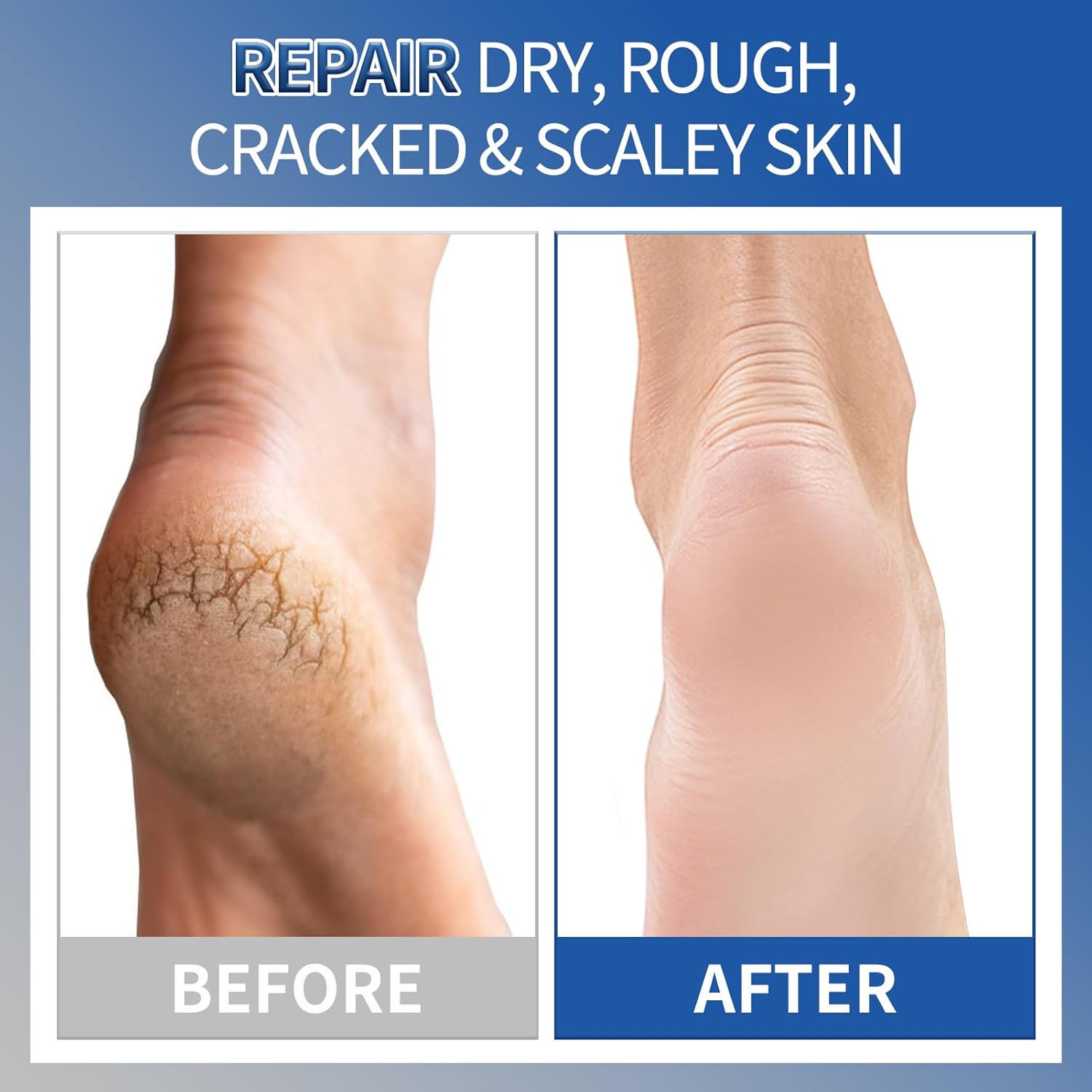 Urea Cream 40 Percent for Feet Maximum Strength, with 2% Salicylic Acid Urea Foot Cream for Dry Cracked Heels and Feet, Tea Tree Oil Foot Cream for Corn and Callus Remover (8.8Oz) - Image 5