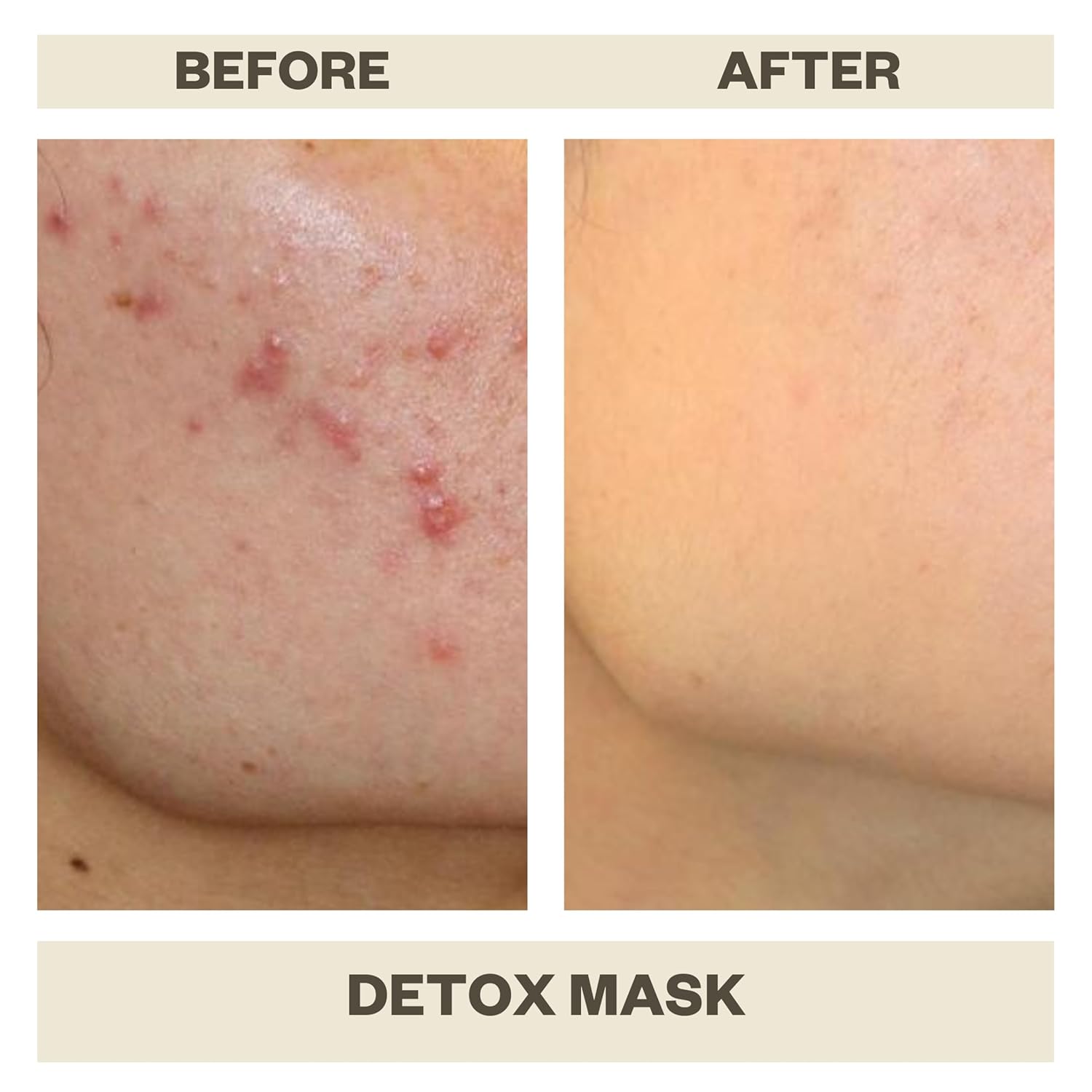 AziMD Skincare Detoxifying Face Mask with 10% Sulfur, Kaolin Clay, Charcoal for Acne, Rosacea Prone Skin, 3 oz - Image 3