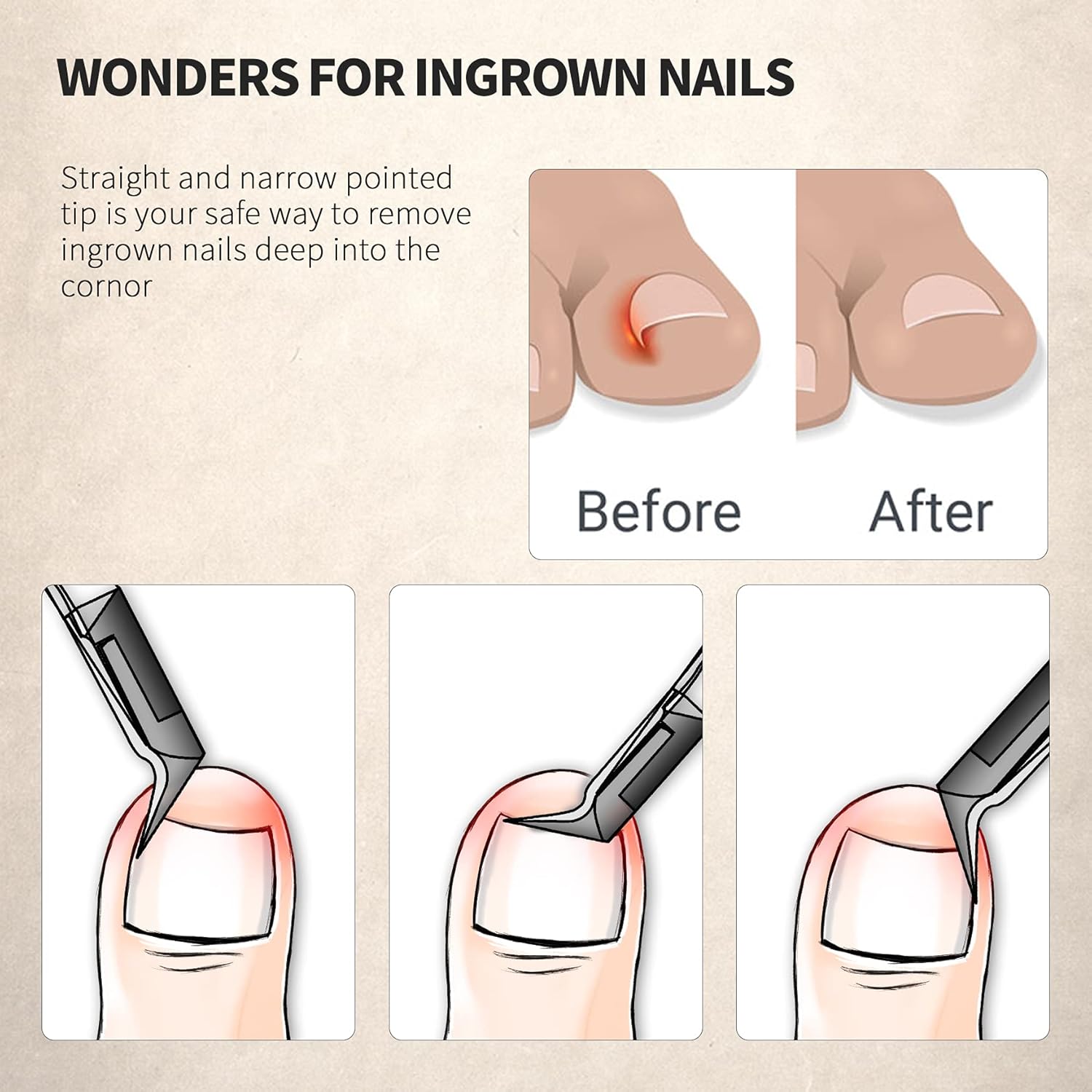 FERYES Toenail Clipper Straight Blade for Ingrown and Thick Nails - Stainless Steel and Sharp Pointed Tip Ingrown Nail Clipper – Wide Jaw Toe Nail Cutter Podiatry Tool - Image 3