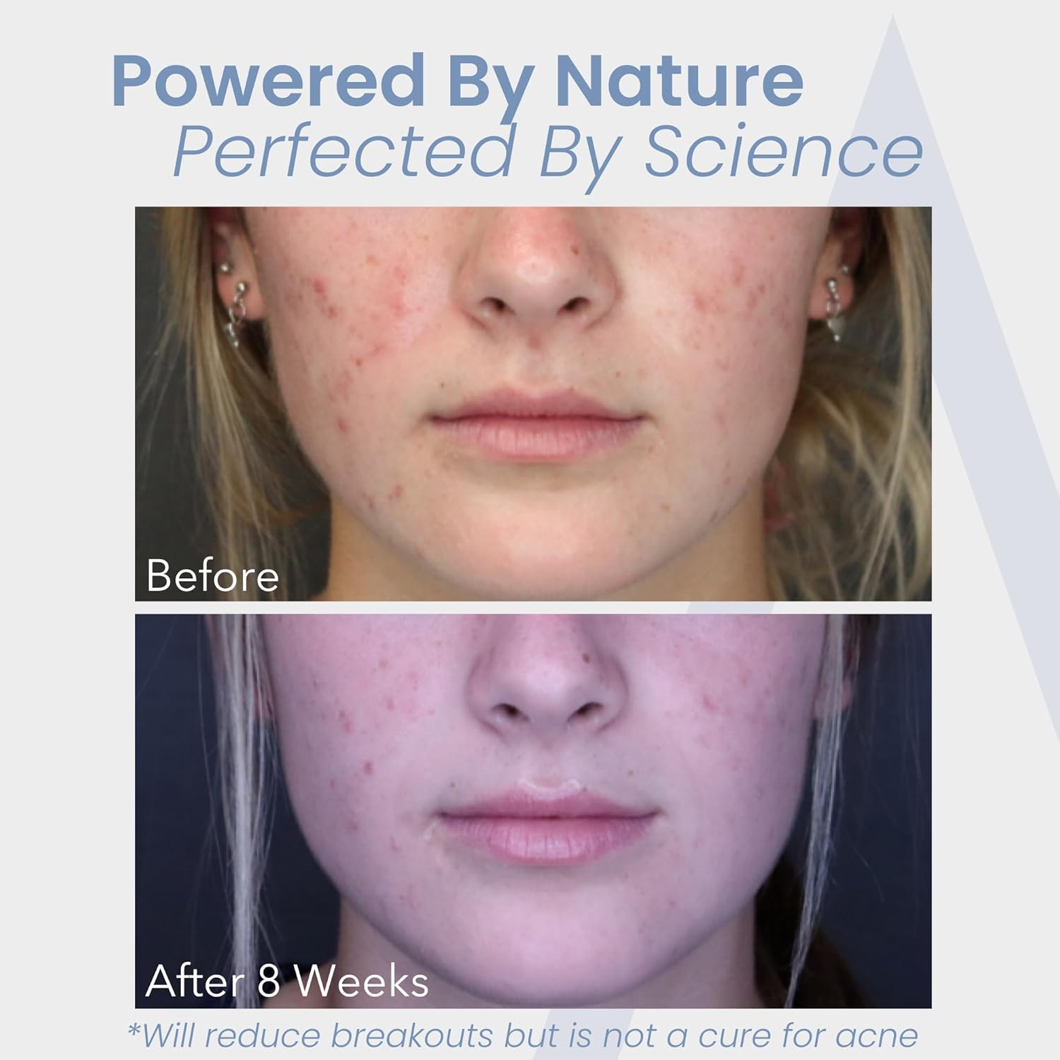 Hormonal Acne Treatment for Women - No DIM - (60 Capsules, 485 mg) – DIM-Free Acne Medication - Helps Nodular & Hormonal Acne - Best Acne Treatment for Teenagers & Adults - Image 5
