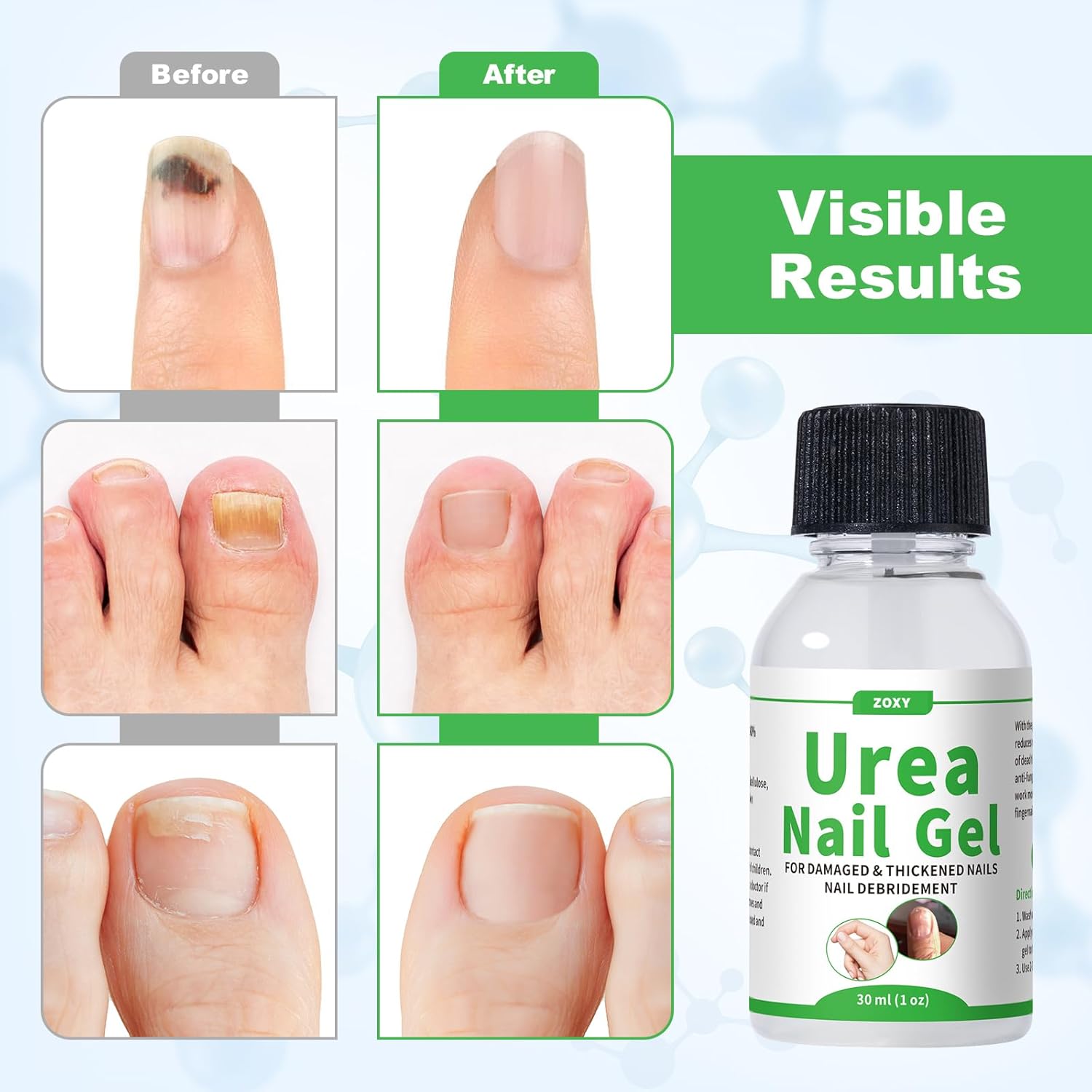 Urea Nail Gel 40% โ Softens Thick Nails & Calluses | Restores Discolored, Damaged Nails | Urea Gel for Nail, Fast-Absorbing - Image 5