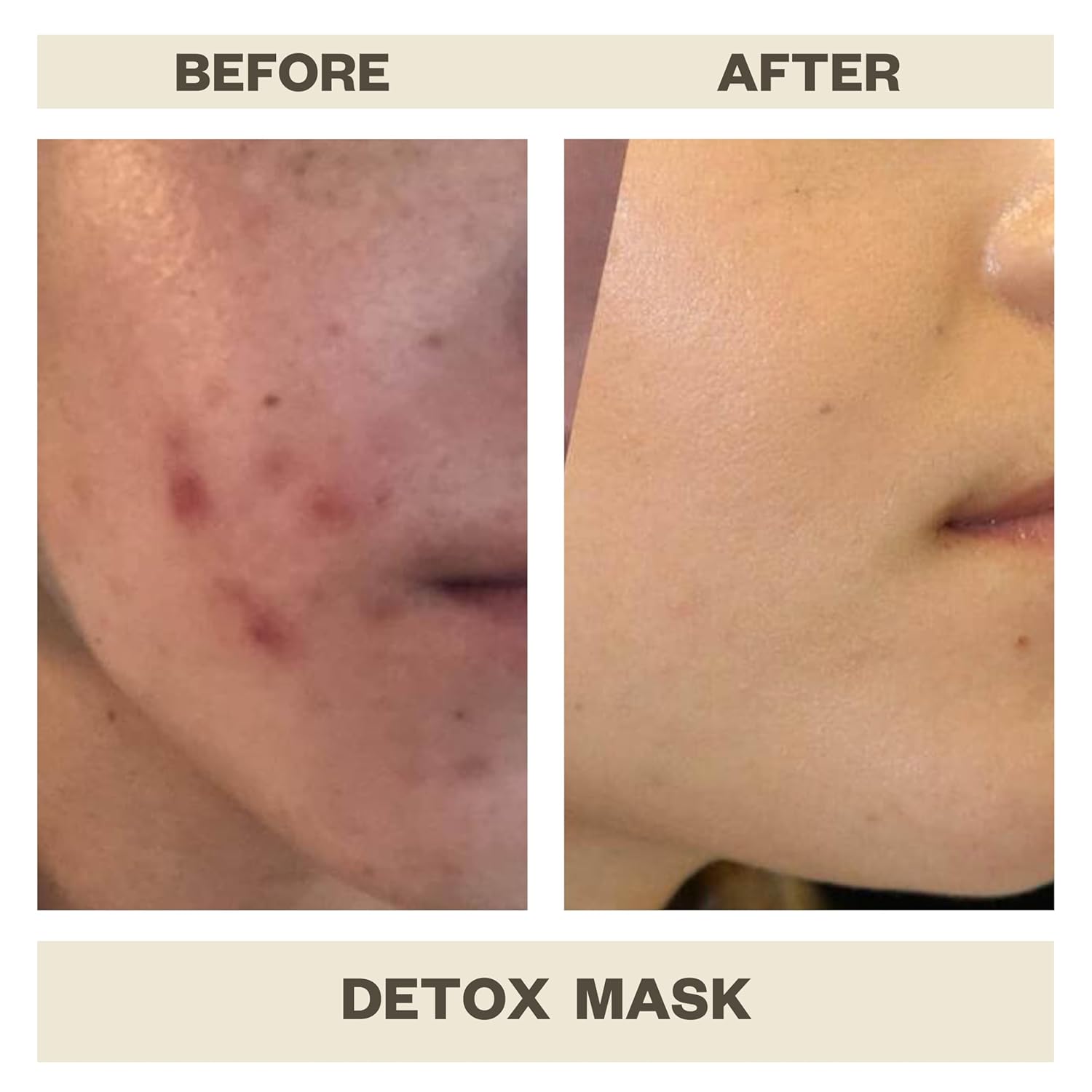 AziMD Skincare Detoxifying Face Mask with 10% Sulfur, Kaolin Clay, Charcoal for Acne, Rosacea Prone Skin, 3 oz - Image 4