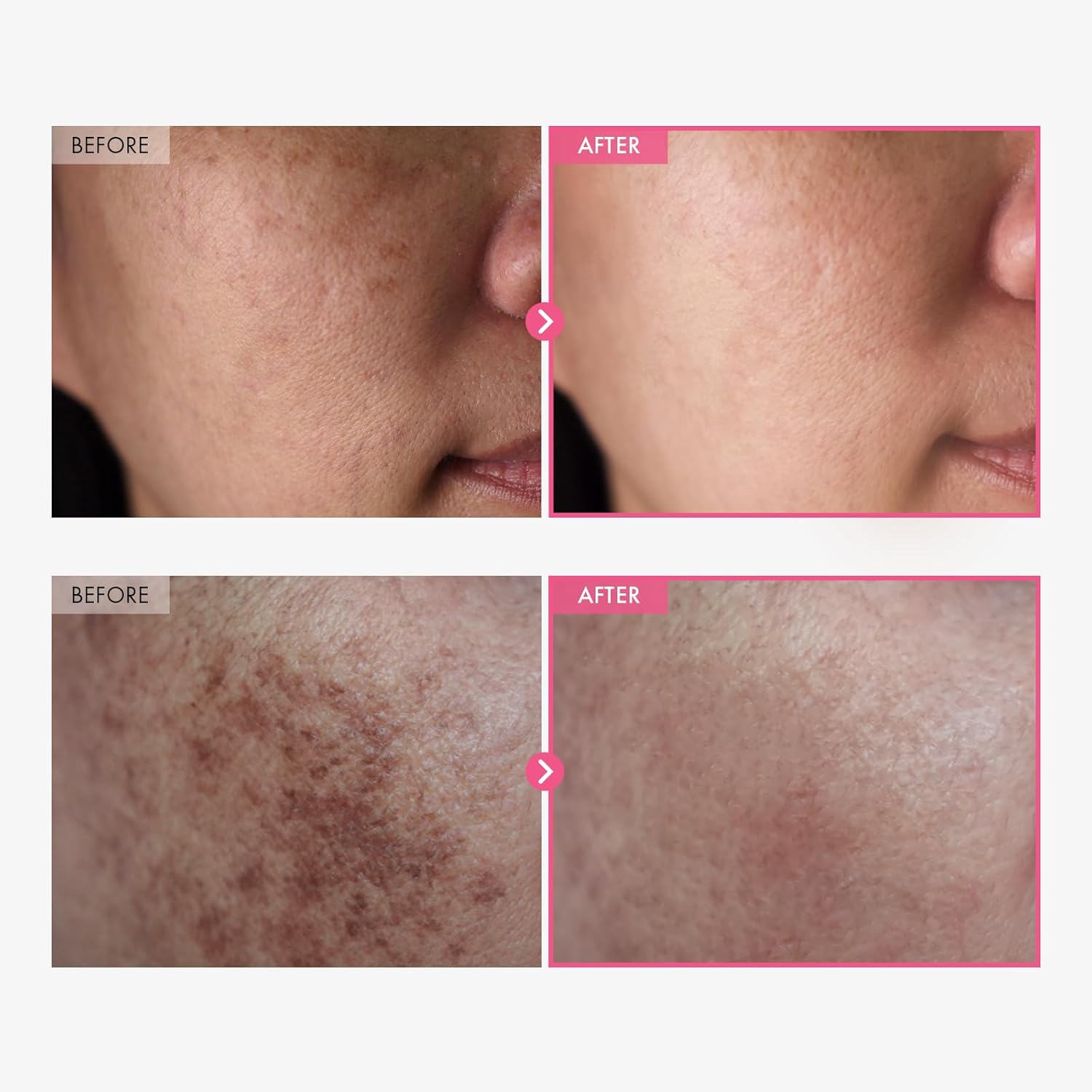Arbutin 7% + Tranexamic Acid 4% Cream, 70,000ppm Arbutin, 40,000ppm TXA, Niacinamide, Glutathione, Dark Spots, Freckle, Blemishes, Pigmentation, Korean Skin Care, 50ml, 1.69 fl.oz. - Image 2
