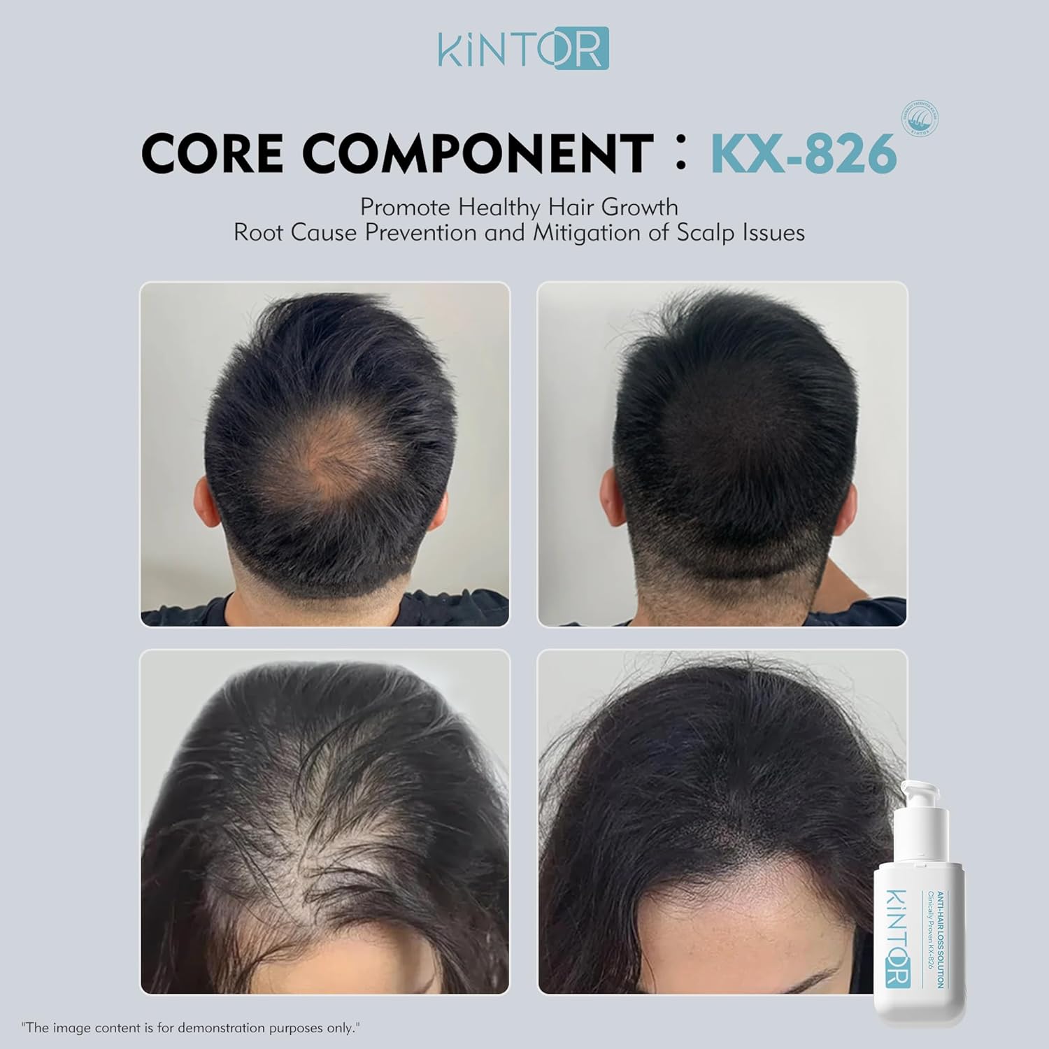 0.5% KX-826 DHT Blocker Hair Regrowth Treatments,3 Days Oil Control 1-2 Weeks Hair Loss Reduction 4-6 Weeks New Hair Visible,Hair Growth Spray Growth Products for Men&Women -1 Month Supply 60ml - Image 2