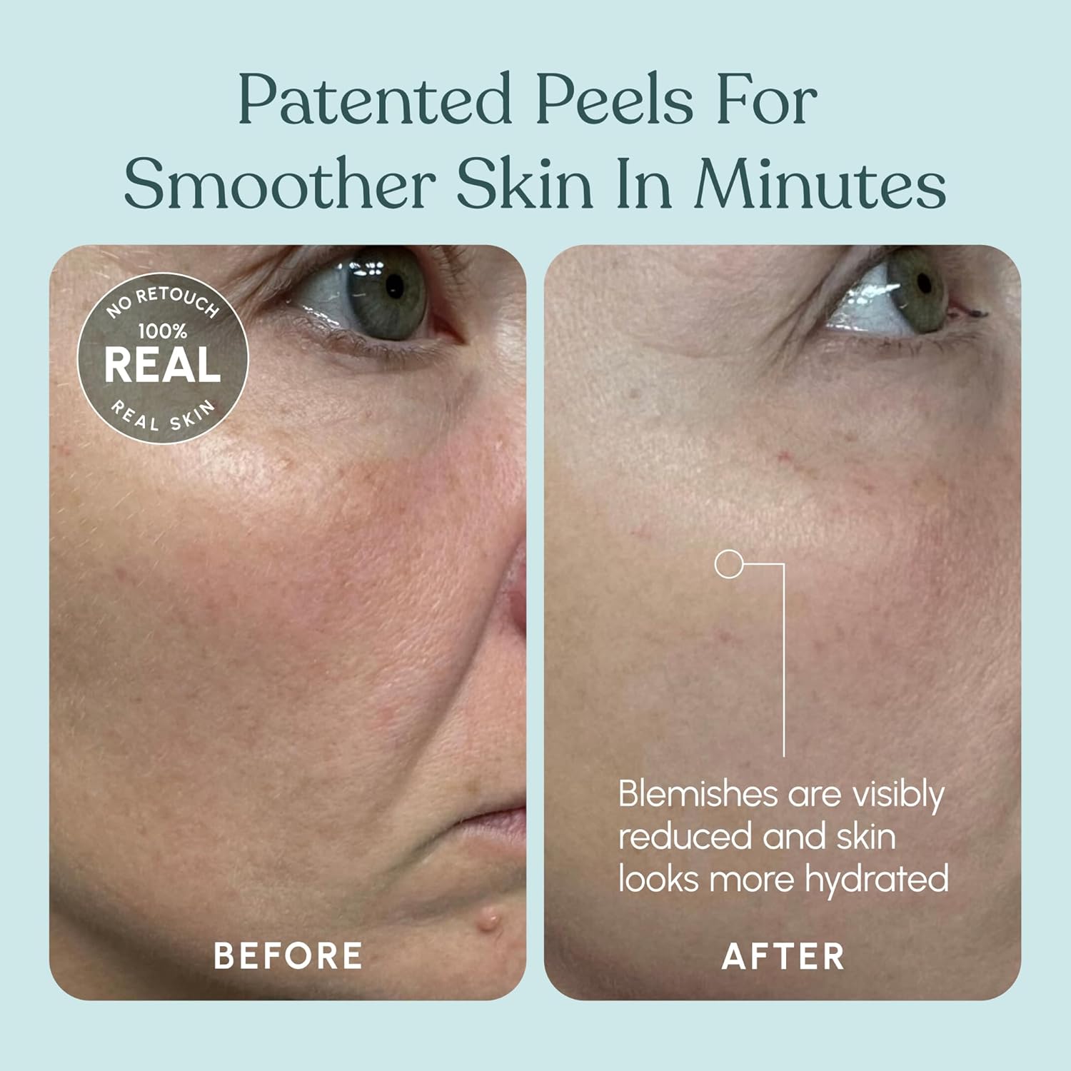 30 DAY MIRACLE AHA 30% + BHA 2% Peeling Solution - Clinical Strength Liquid Exfoliant for Dark Spots, Blackheads & Clogged Pores - Resurfacing Salicylic Acid Serum & Chemical Peel for Face - Image 9