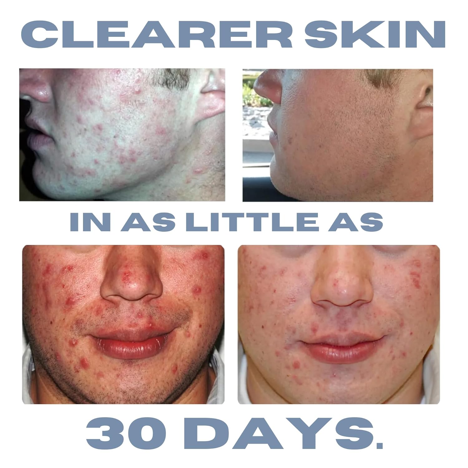 Sensitive Skin Sulfur Acne Lotion Treatment Cream 1.8 Fl Oz Ointment - Image 5