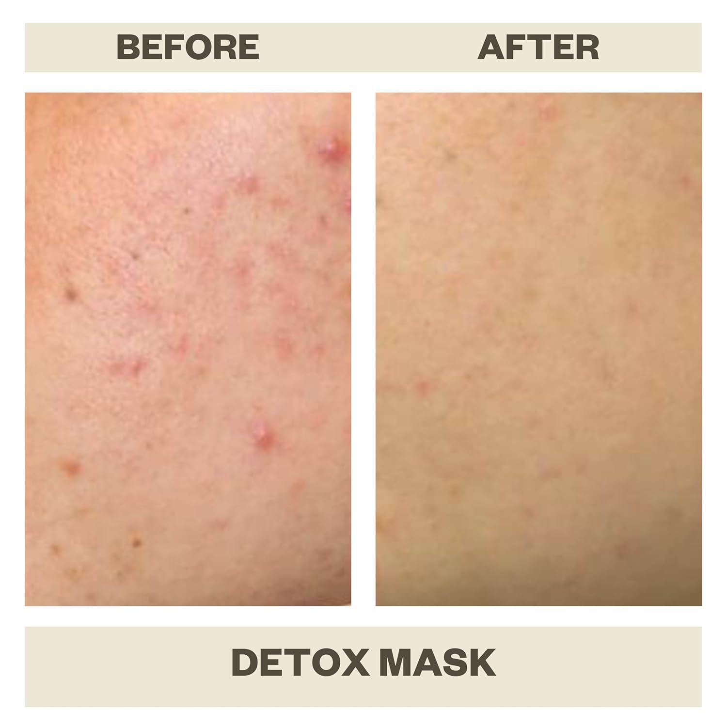 AziMD Skincare Detoxifying Face Mask with 10% Sulfur, Kaolin Clay, Charcoal for Acne, Rosacea Prone Skin, 3 oz - Image 2