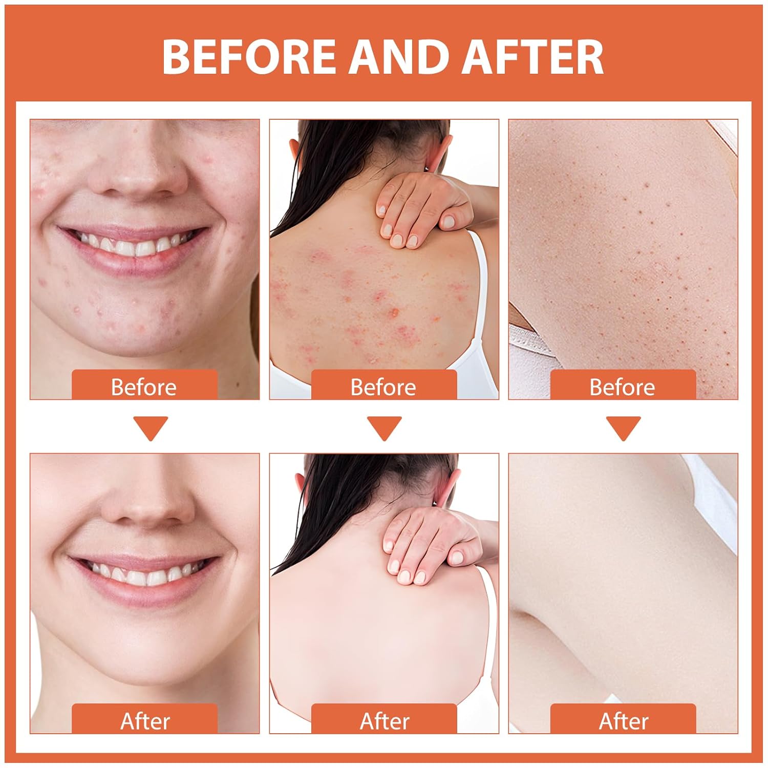 Acne Cream, Salicylic Acid Cystic Acne Treatment For Face, Back Butt Acne Treatments Creams, Acne Spot Treatment for Face Body, Acne Clearing Pimple Cream for Teens & Adults, Acne Moisturizer - Image 4