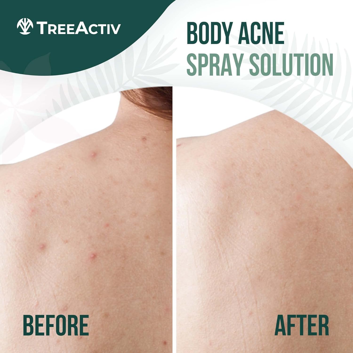 Salicylic Acid and Tea Tree Oil Back and Body Acne Spray, 4 fl oz Bottles, 2-Pack - Image 2