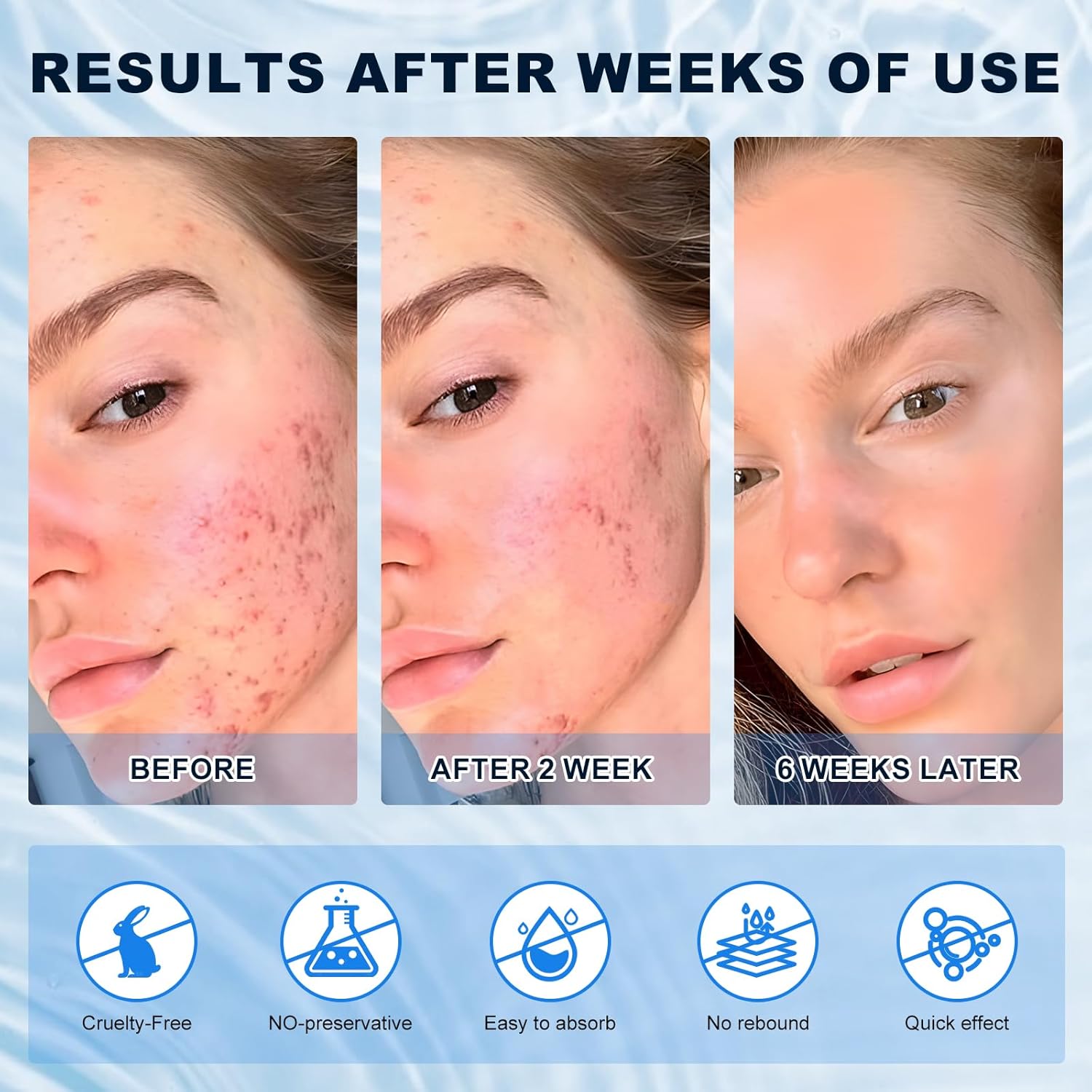 10% Azelaic Acid Cream for Face - Acne Cream for Rosacea Reducing Relief Pimple Breakouts Blackhead Pigmentation and Redness - Azelaic Acid Gel For Facial and Skin Care - Image 4
