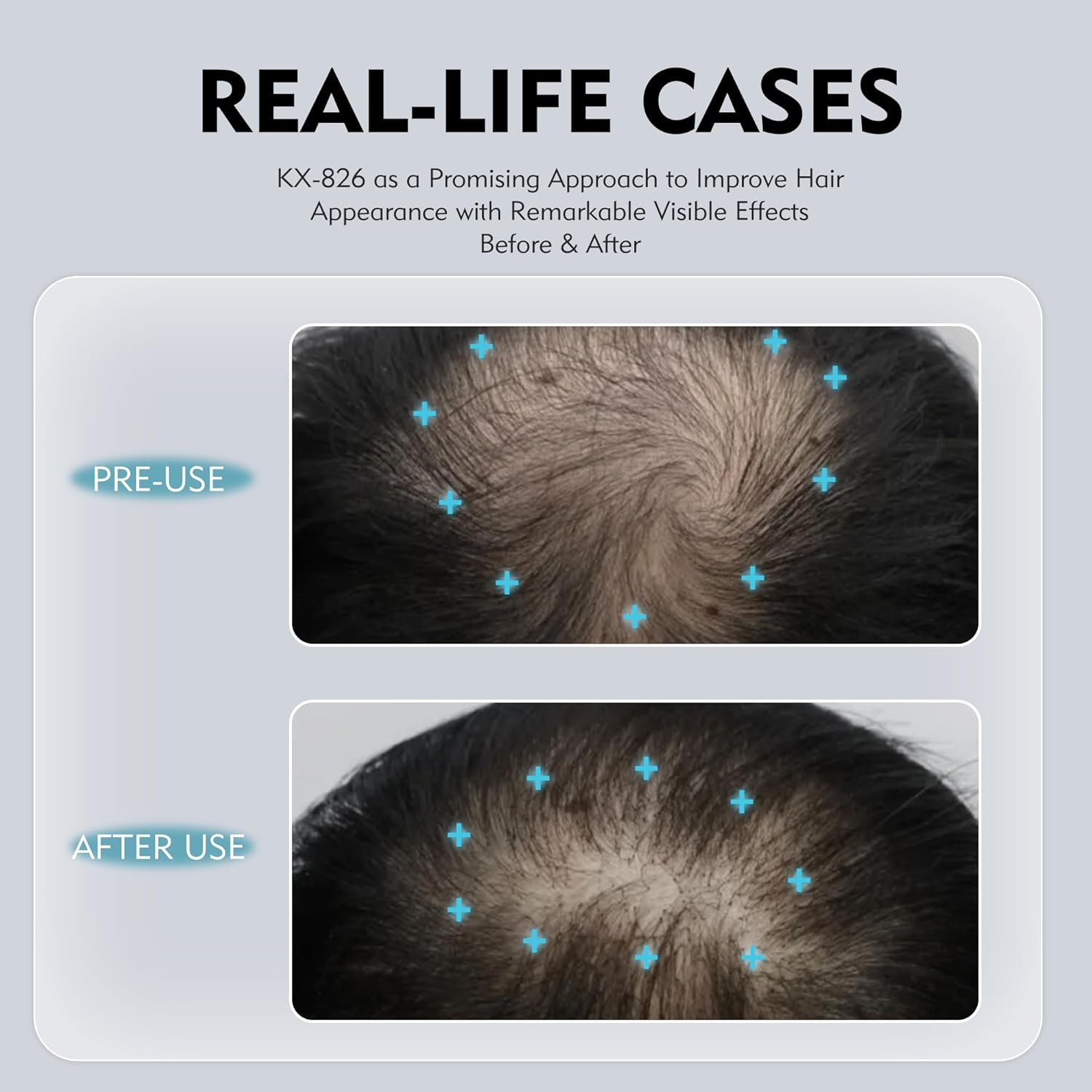 0.5% KX-826 DHT Blocker Hair Regrowth Treatments,3 Days Oil Control 1-2 Weeks Hair Loss Reduction 4-6 Weeks New Hair Visible,Hair Growth Spray Growth Products for Men&Women -1 Month Supply 60ml - Image 5