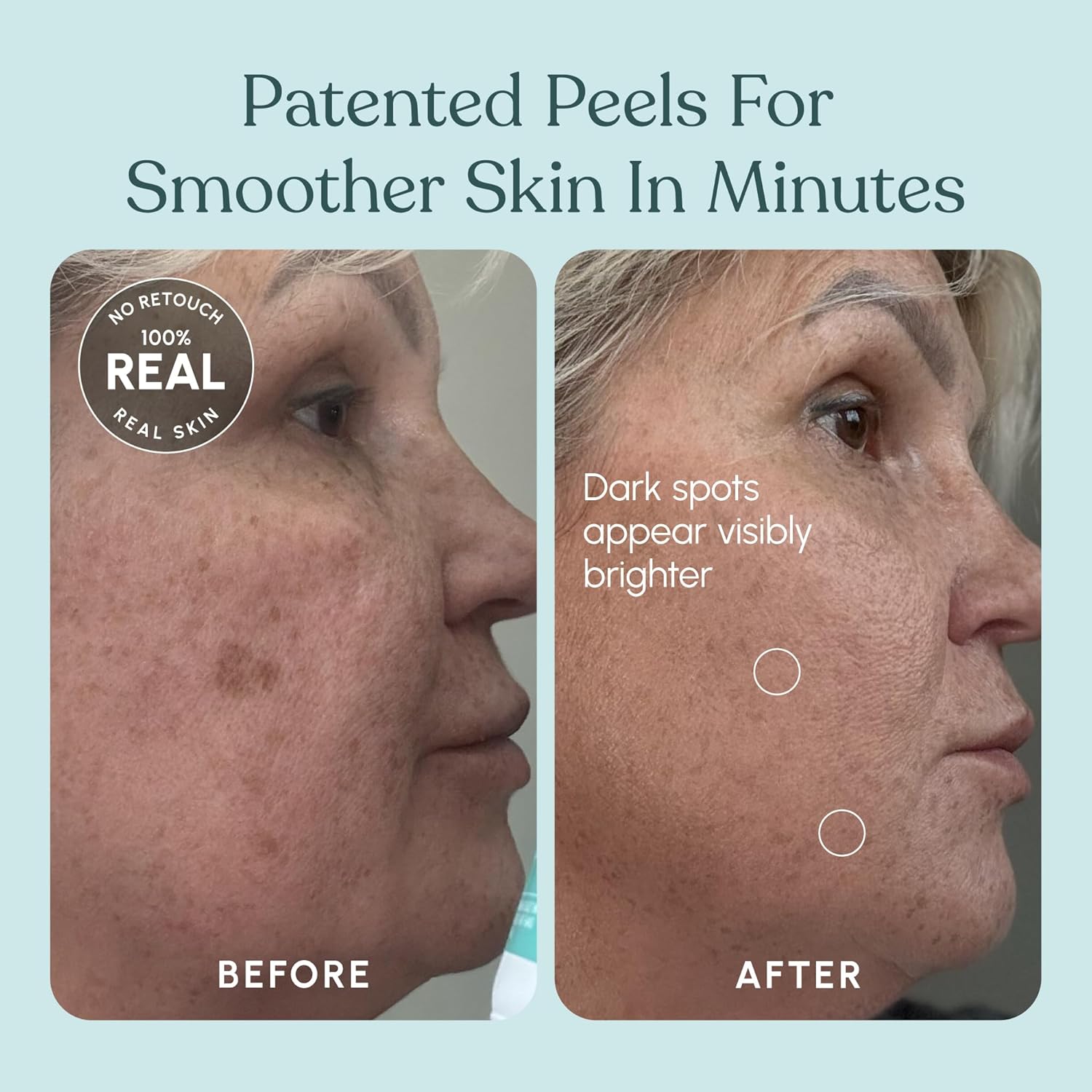30 DAY MIRACLE AHA 30% + BHA 2% Peeling Solution - Clinical Strength Liquid Exfoliant for Dark Spots, Blackheads & Clogged Pores - Resurfacing Salicylic Acid Serum & Chemical Peel for Face - Image 8