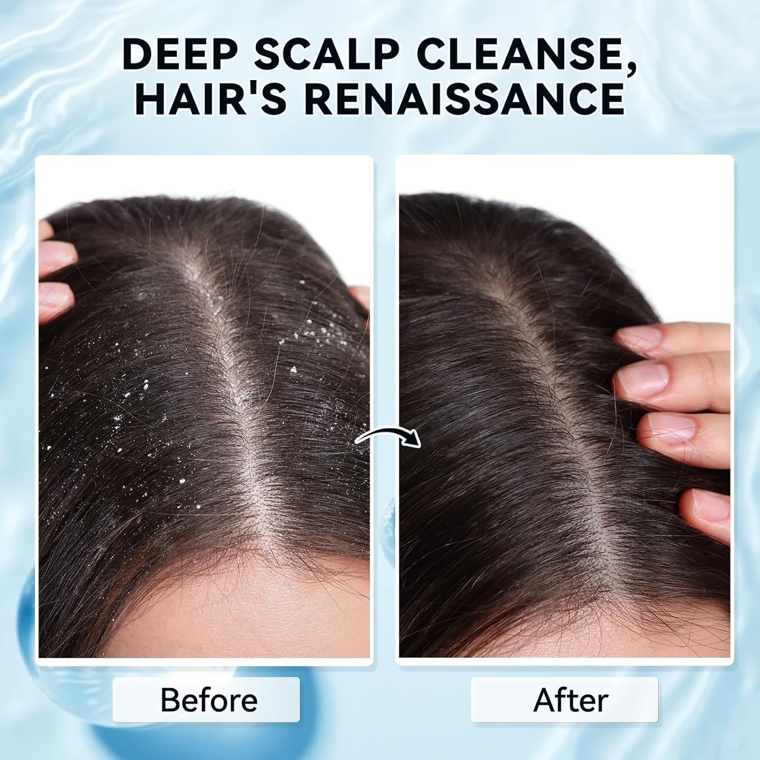 Scalp Scrub with Scalp Scrubber, Dry itchy Scalp & Dandruff Treatment, Scalp Exfoliator, Deep Cleans, Gentle Formula , 8.45 oz - Image 5
