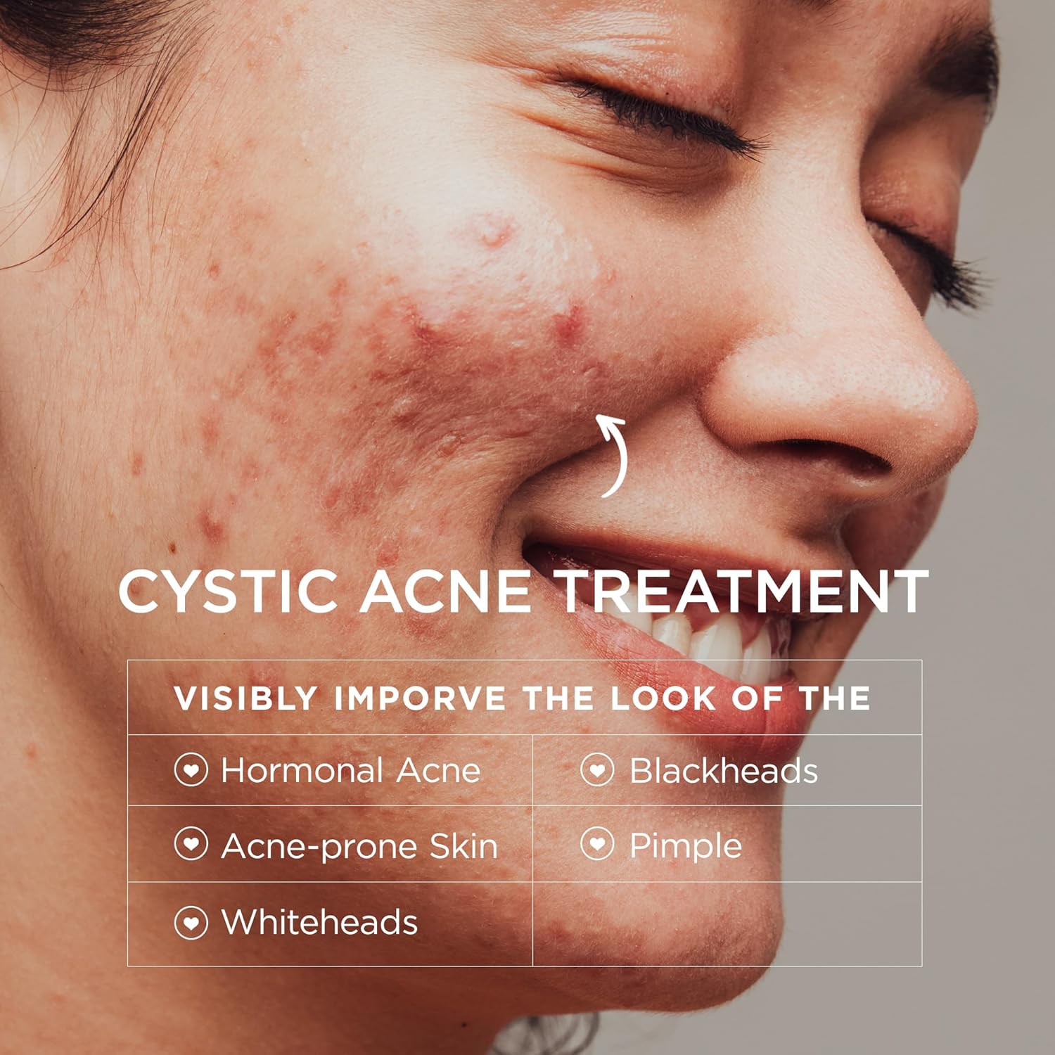 Acne Treatment for Face: Cystic Acne Spot Control Cream with Salicylic Acid & Tea Tree Oil for Blemishes - Gentle Hormonal & Pimple Treatment for Teens & Adults - 120 Day Supply & 3.38oz - Image 3