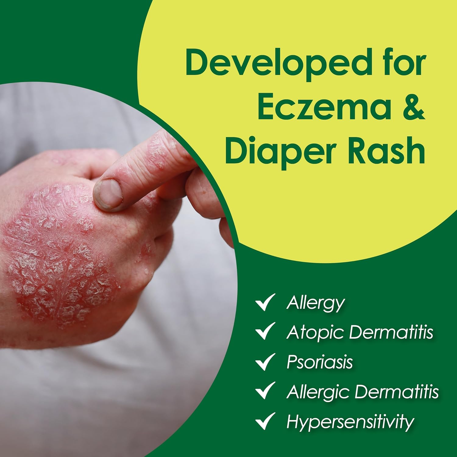 Eczema Dermatitis Sensitive Skin Natural Repair Essential Oil 30ML Tube - Image 6