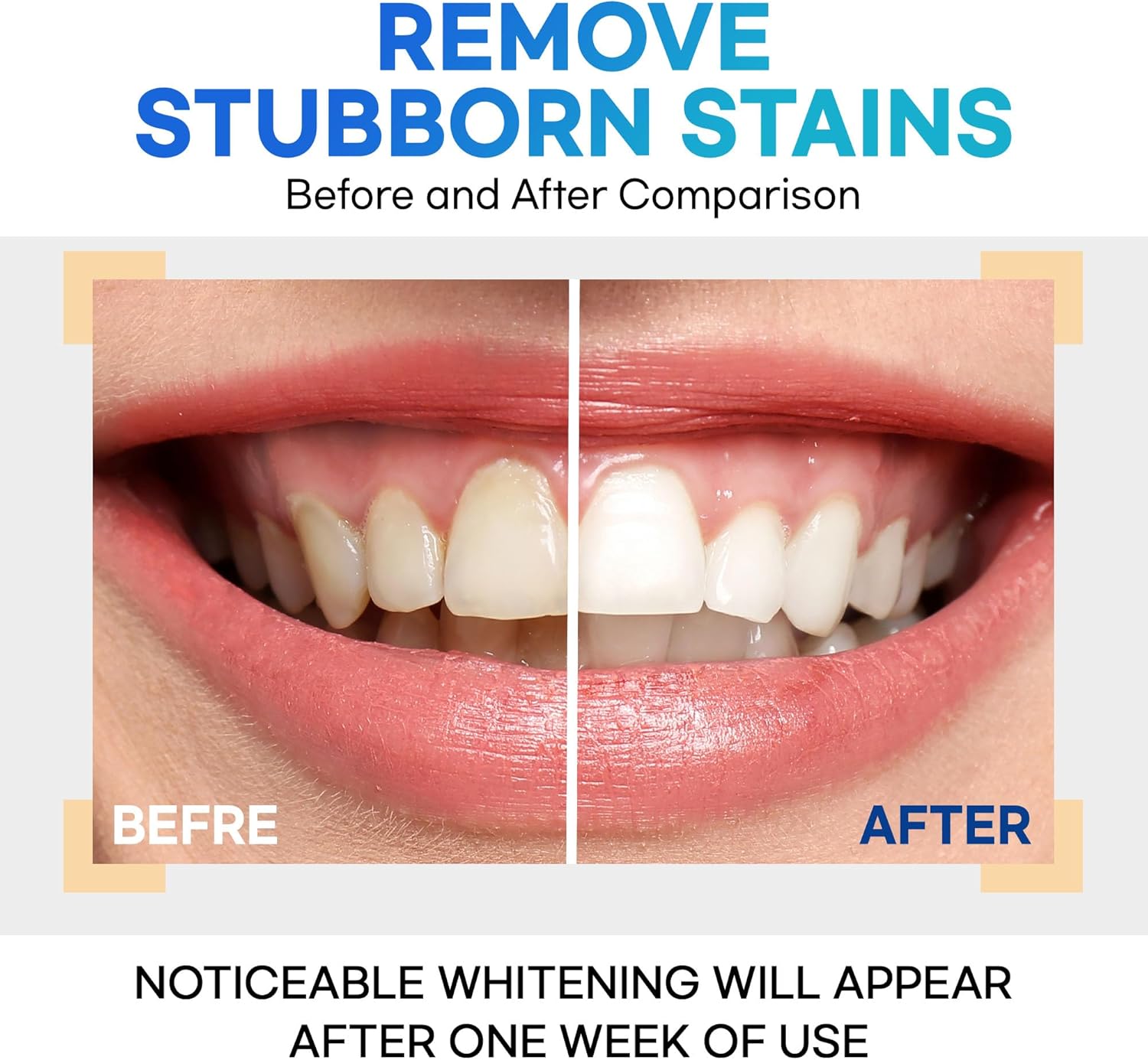 Teeth Whitening Gel – Set of 3 – Gentle, Pain-Free Formula for Sensitive Teeth – Easy, Mess-Free Application – Travel-Friendly & Enamel-Safe for a Brighter Smile - Image 2