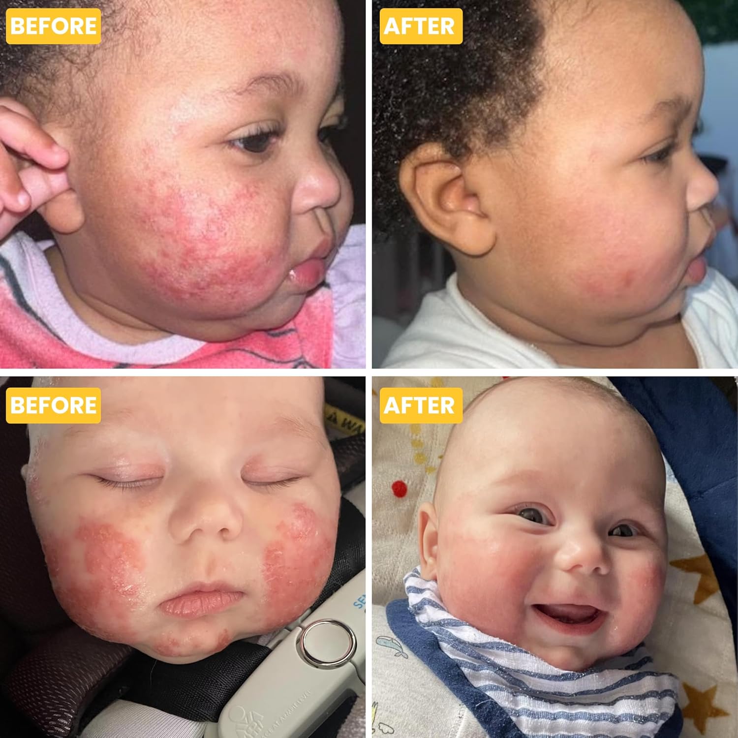 Gentle Baby Eczema Cream Moisturizer for Newborn to 12 Years, 75g, Steroid-Free - Image 8
