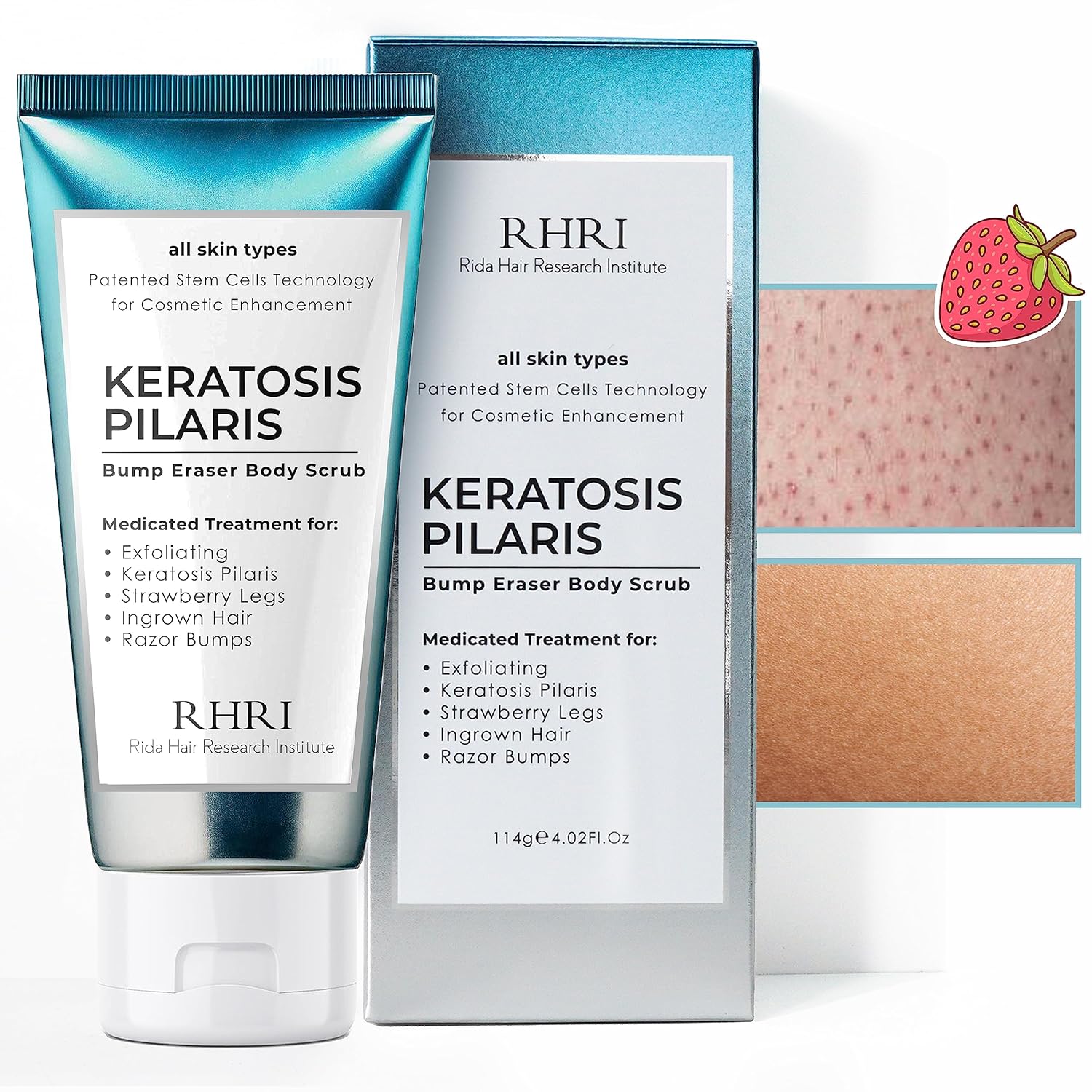 KP Bump Eraser Body Scrub | Keratosis Pilaris Treatment | Bump Eraser Body Scrub | Exfoliating Body Scrun | Ingrown Hair Treatment | Clears Strawberry Legs | Soothes Redness, Dryness & Flaky Skin
