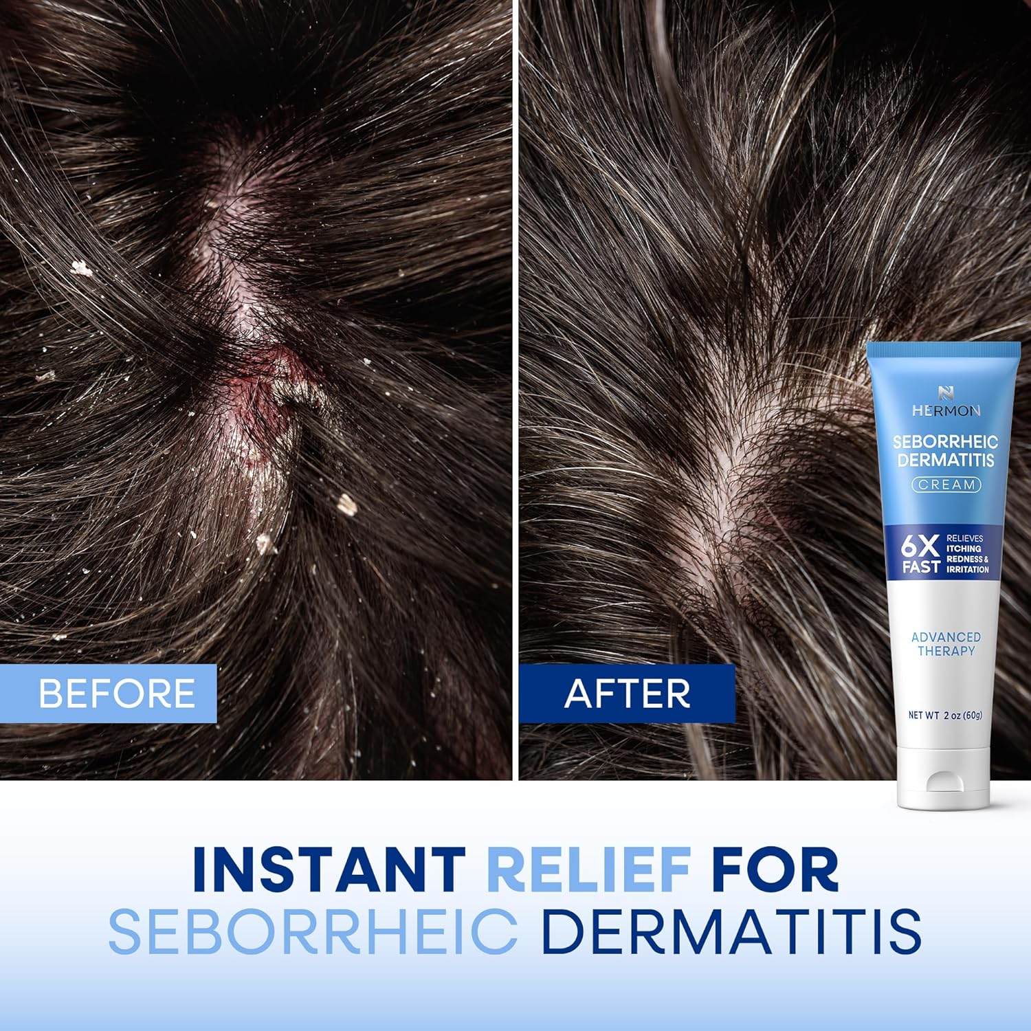Fast-Acting Seborrheic Dermatitis Cream for Scalp, Face, and Body - 1 Pack Anti-Itch Ointment - Image 4