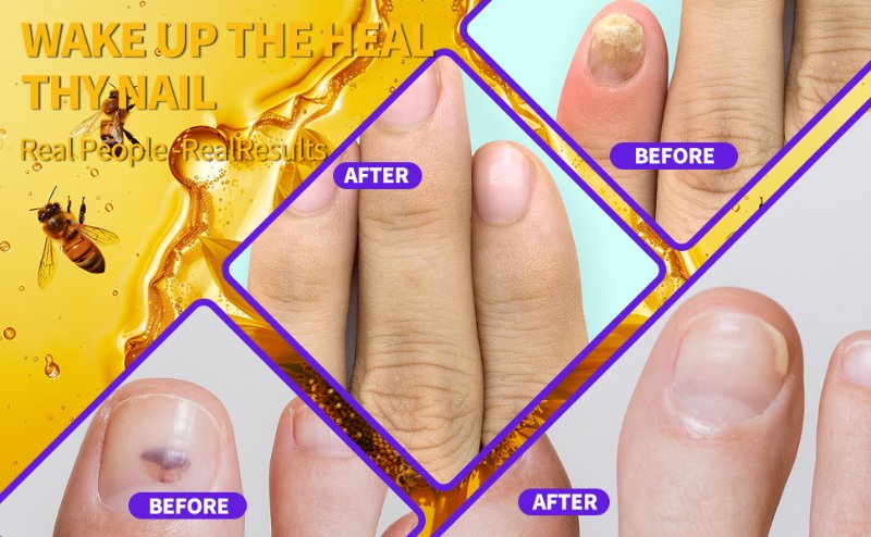 Toenail Fungus Treatment