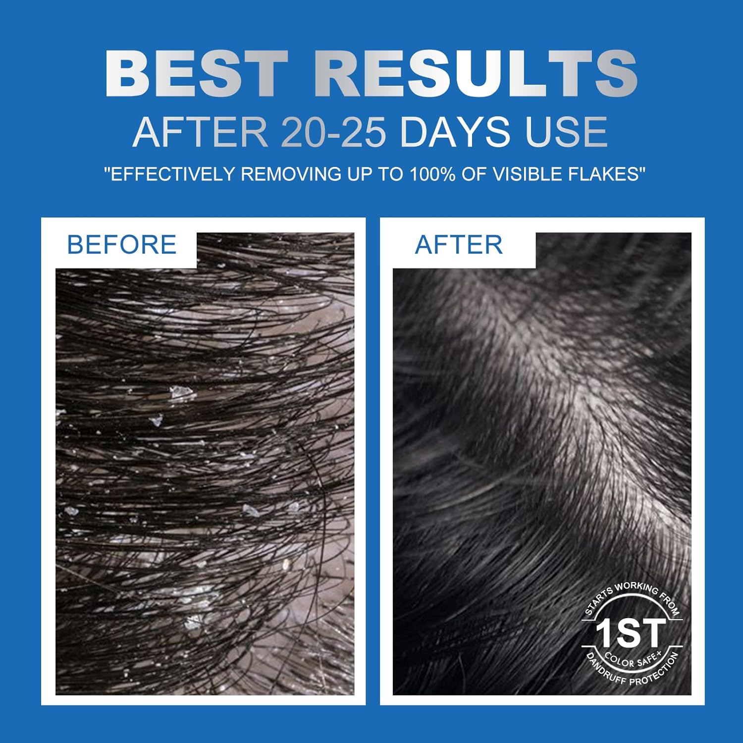 Ceson&Cesun Anti-Fungal/Anti Dandruff 2 in 1 Shampoo for Folliculitis, Scalp Psoriasis & Seborrheic Dermatitis, Itchy & Dry Scalp Relief, Nourishes, Hydrates, Control Oil, Safe For Color-Treated Hair - Image 3