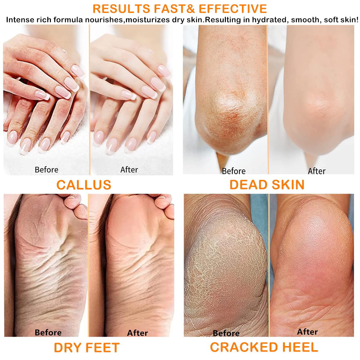 Urea Cream 40 Percent for Foot and Dry Cracked Heel 40% Urea Feet Cream Balm Stick for Foot Hand Moisturizing Feet Hand Care Balm For Women Men 1.06Oz - Image 6