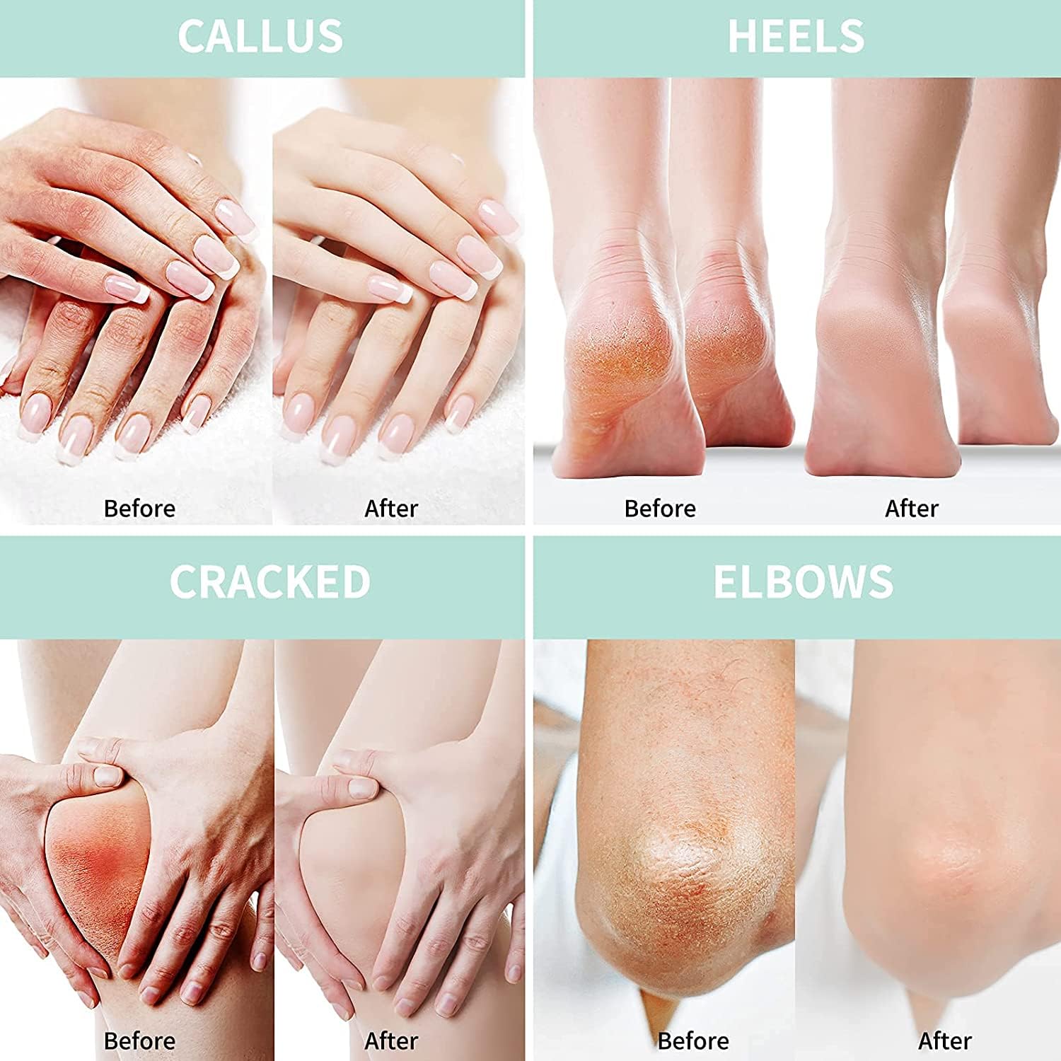 Urea Cream 40 Percent For Feet Plus 2% Salicylic Acid 8.82 oz || Foot Cream and Hand Cream Maximum Strength with Hyaluronic Acid, Tea Tree,and Aloe Vera for Deep Moisturizes, Callus Remover and Soften - Image 6