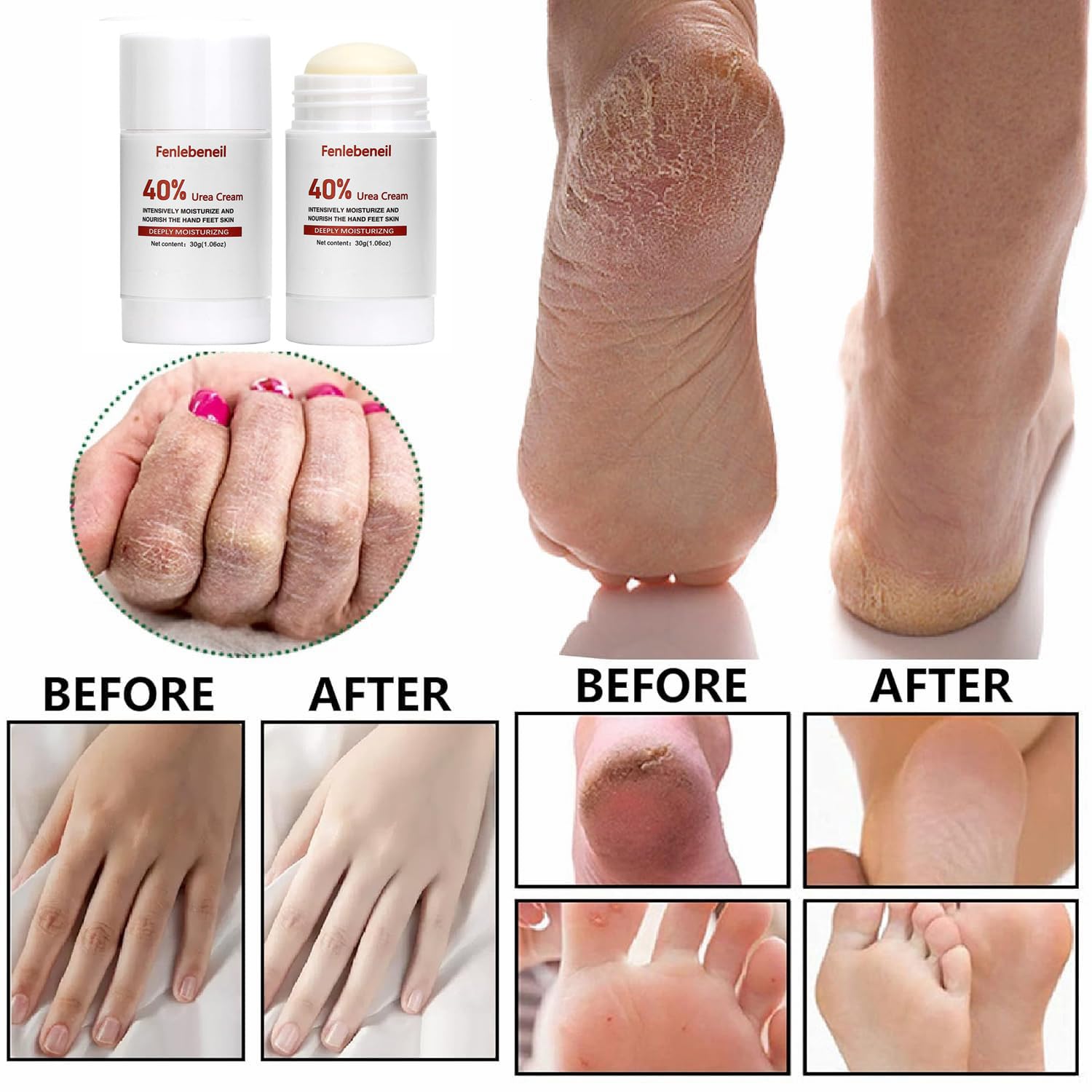Urea Cream 40 Percent for Foot and Dry Cracked Heel 40% Urea Feet Cream Balm Stick for Foot Hand Moisturizing Feet Hand Care Balm For Women Men 1.06Oz - Image 3
