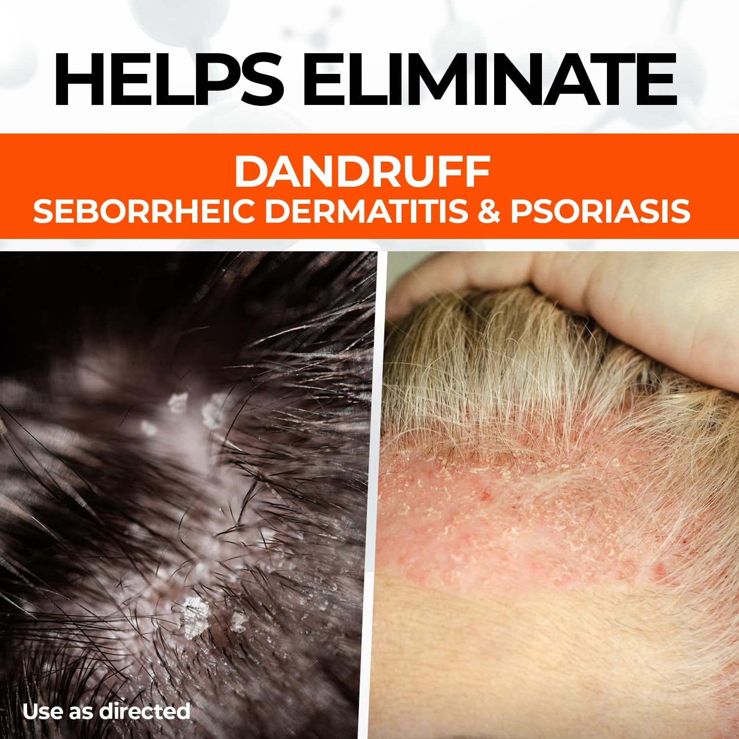 Medicasp Coal Tar Anti-Dandruff Shampoo, Alleviates Symptoms from 1st Wash, Treats Psoriasis, Seborrheic Dermatitis & Itchy Dry Scalp, Fights the Root Cause of Dandruff, Flakes Shampoo, 6 fl oz - Image 3